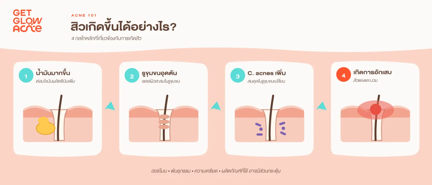 สิวเกิดขึ้นได้อย่างไร — 4 กลไกหลัก: น้ำมันมากขึ้น รูขุมขนอุดตัน C. acnes เพิ่ม และเกิดการอักเสบ