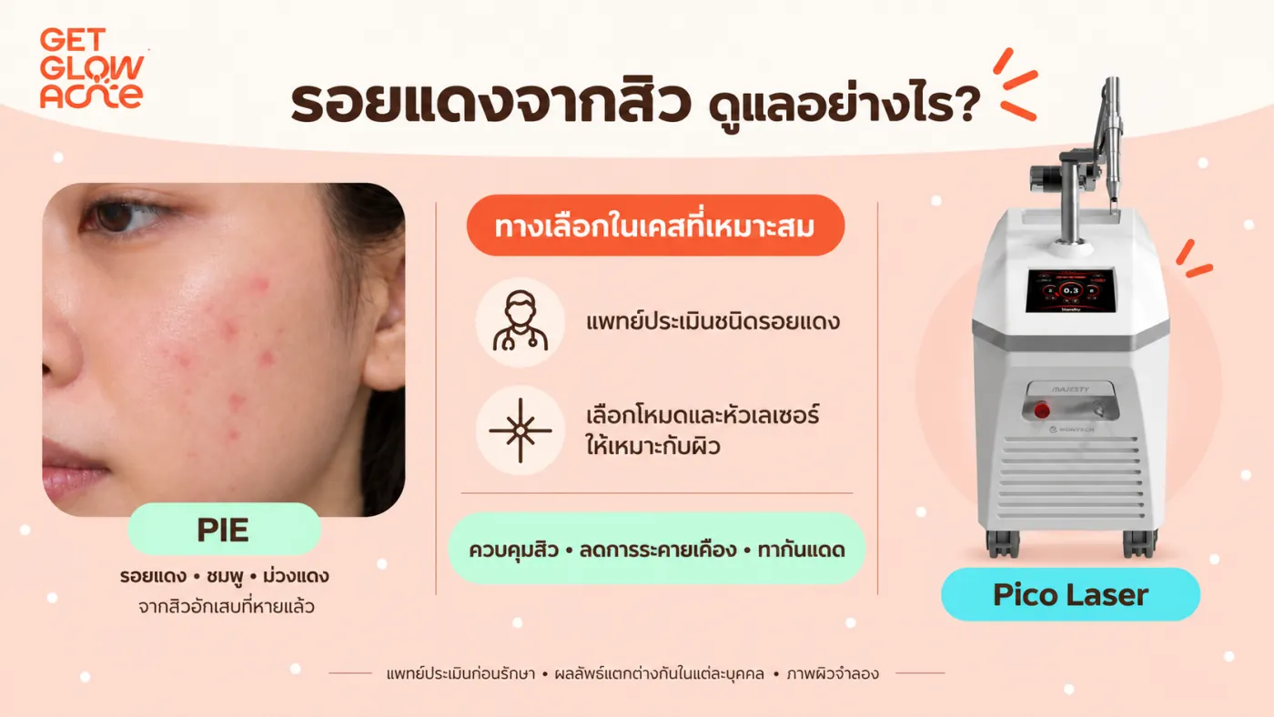 รอยแดงจากสิว (PIE) ดูแลอย่างไร — แพทย์ประเมินชนิดรอยแดง เลือกโหมดและหัวเลเซอร์ Pico ให้เหมาะกับผิว ควบคู่กับควบคุมสิวและทากันแดด