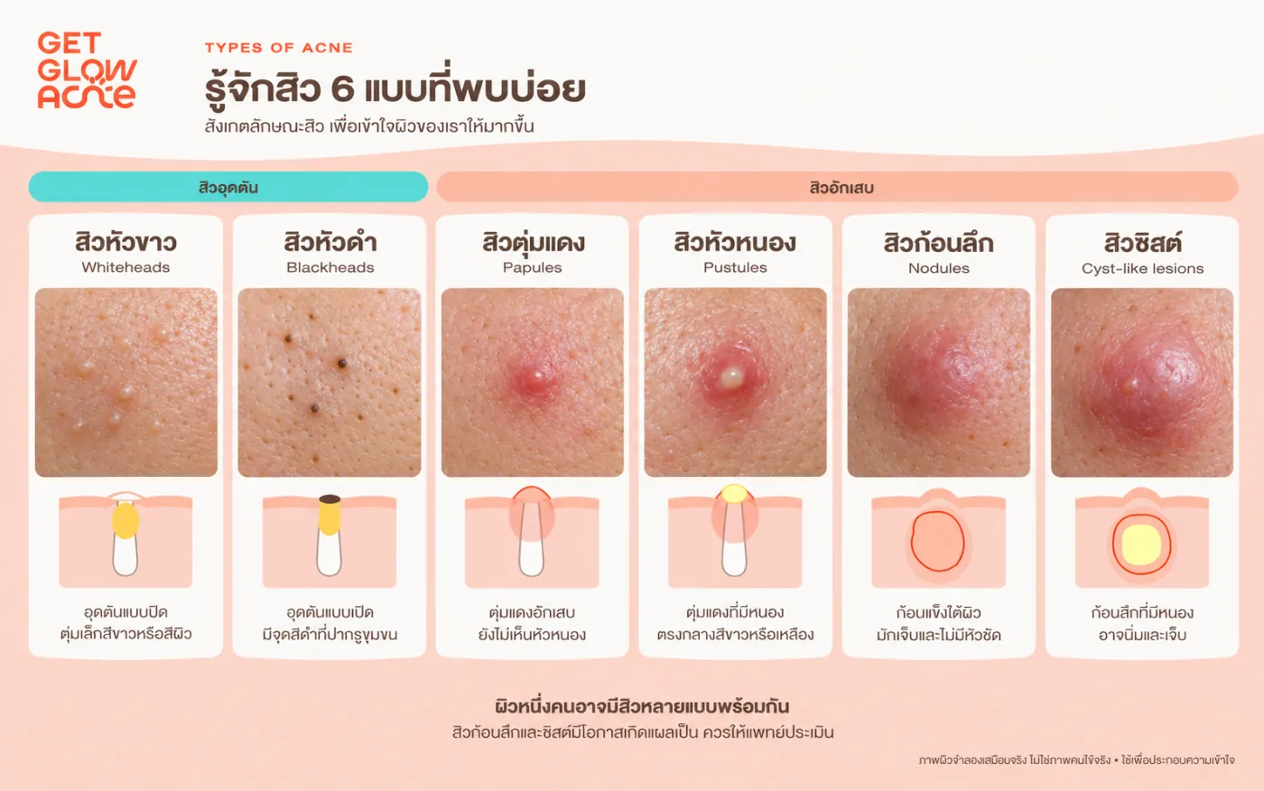 สิว 6 แบบที่พบบ่อย: สิวหัวขาว สิวหัวดำ สิวตุ่มแดง สิวหัวหนอง สิวก้อนลึก และสิวซิสต์