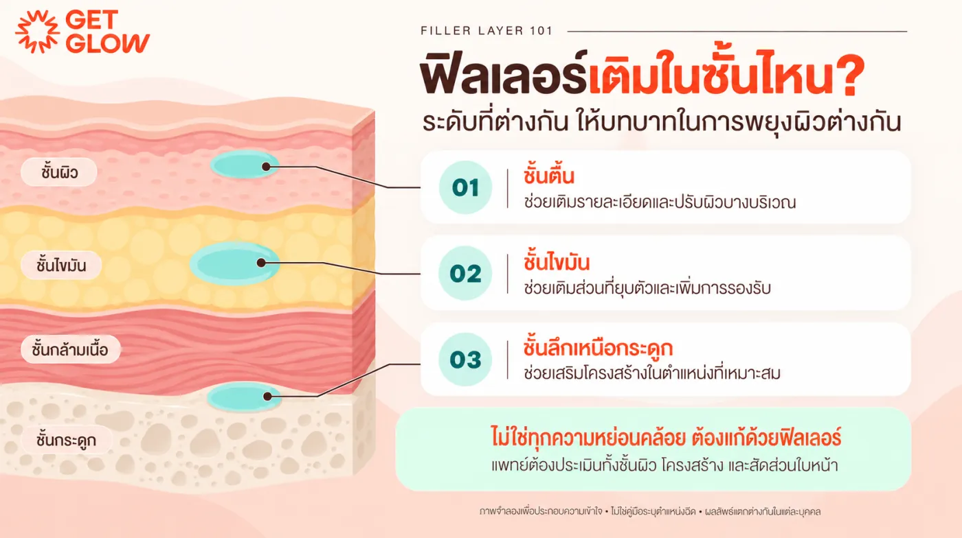 ฟิลเลอร์เติมในชั้นไหน — ชั้นตื้น ชั้นไขมัน ชั้นลึกเหนือกระดูก — เติมส่วนที่ยุบตัว เพิ่มการรองรับ และปรับความสมดุล พร้อมตำแหน่งขมับ ใต้ตา กลางแก้ม ร่องข้างจมูก และคาง