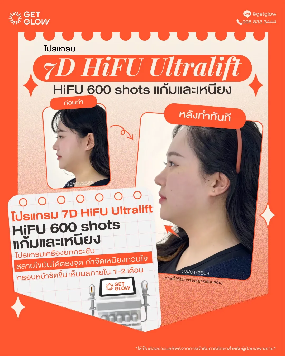 รีวิวจริง 7D HIFU — 600 shots · แก้มและเหนียง · หลังทำทันที ที่ GETGLOW Clinic สยามสแควร์วัน