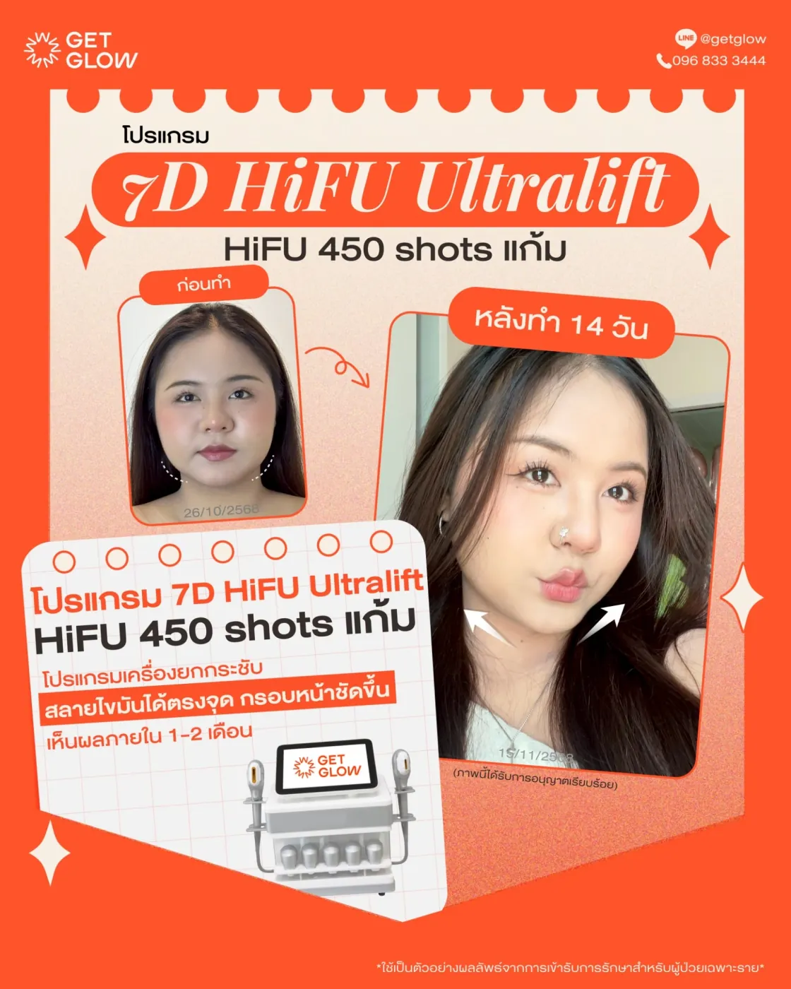 รีวิวจริง 7D HIFU — 450 shots · แก้ม · หลังทำ 14 วัน ที่ GETGLOW Clinic สยามสแควร์วัน