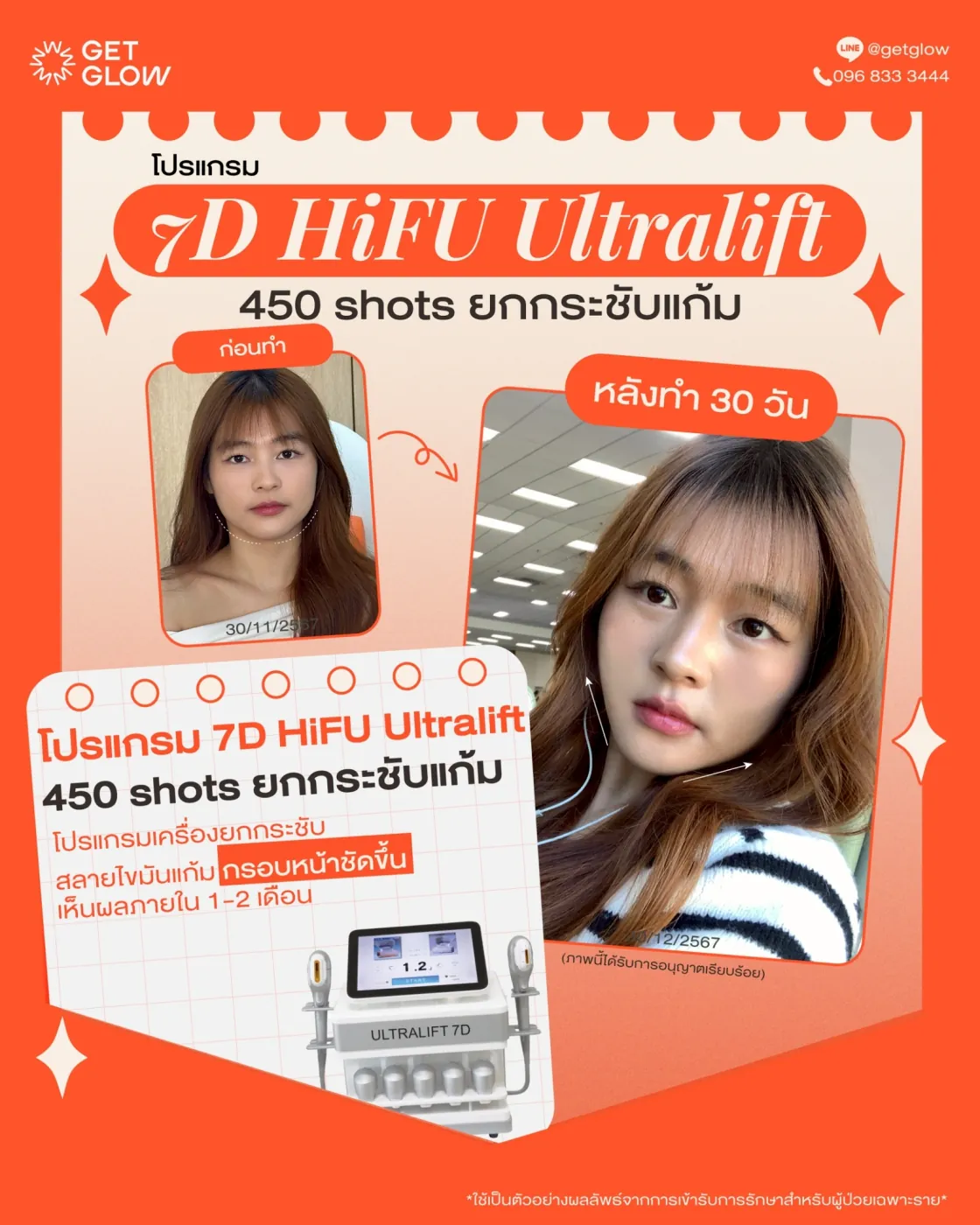 รีวิวจริง 7D HIFU — 450 shots · ยกกระชับแก้ม · หลังทำ 30 วัน ที่ GETGLOW Clinic สยามสแควร์วัน
