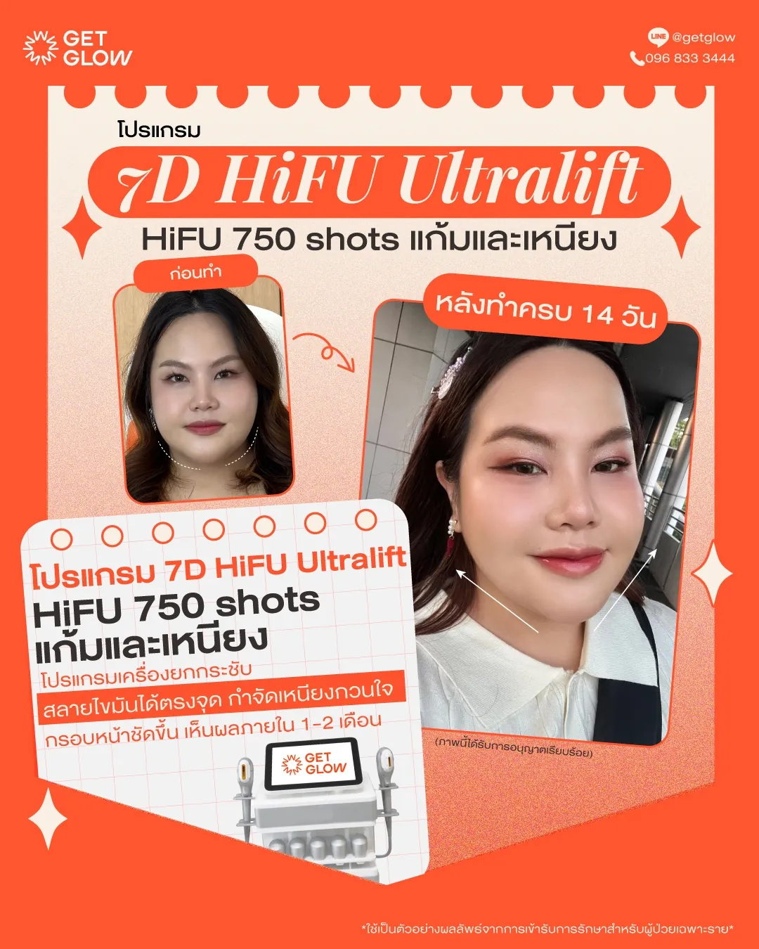 รีวิวจริง 7D HIFU — 750 shots · แก้มและเหนียง · หลังทำ 14 วัน ที่ GETGLOW Clinic สยามสแควร์วัน