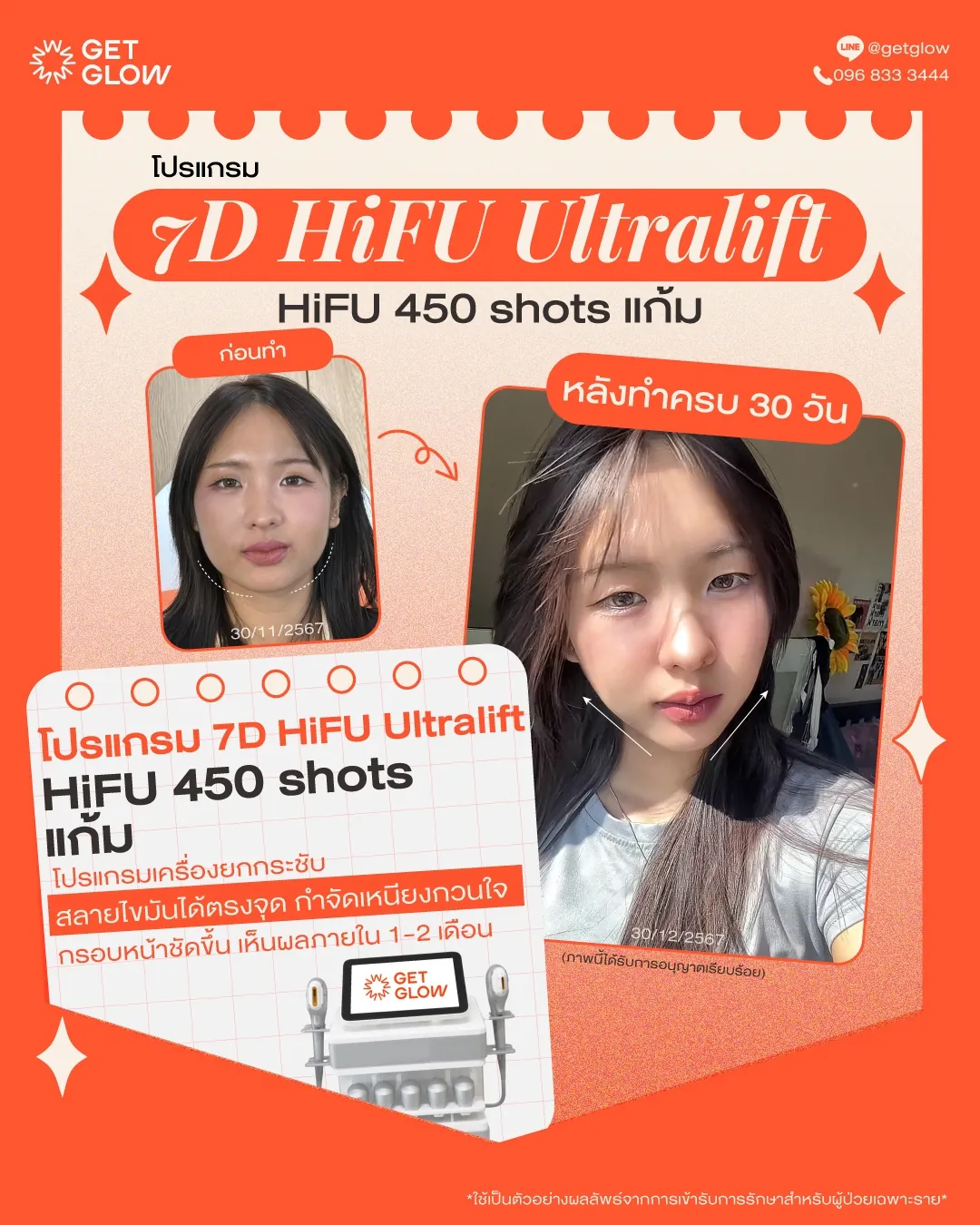 รีวิวจริง 7D HIFU — 450 shots · แก้ม · หลังทำ 30 วัน ที่ GETGLOW Clinic สยามสแควร์วัน