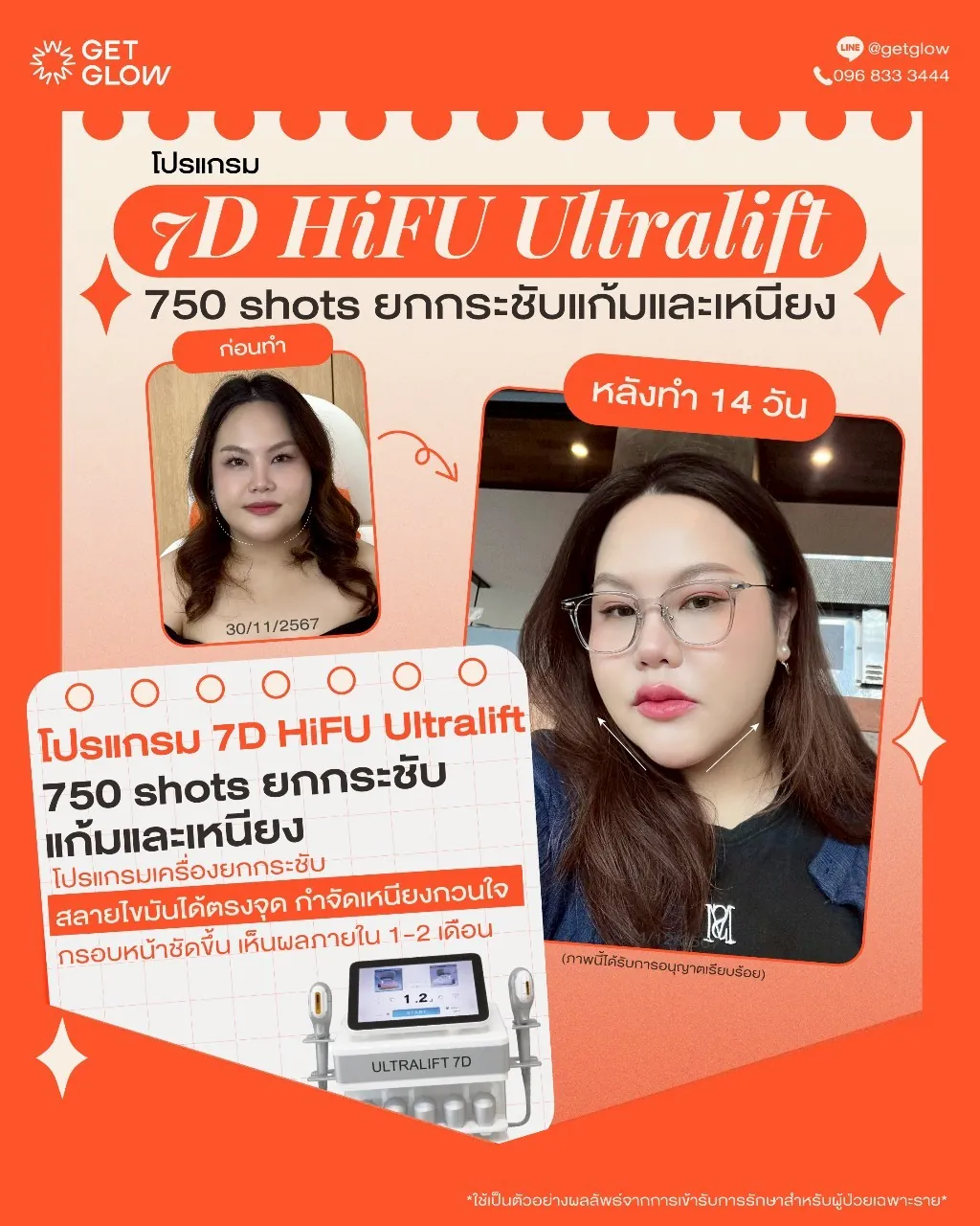 รีวิวจริง 7D HIFU — 750 shots · แก้มและเหนียง · หลังทำ 14 วัน ที่ GETGLOW Clinic สยามสแควร์วัน