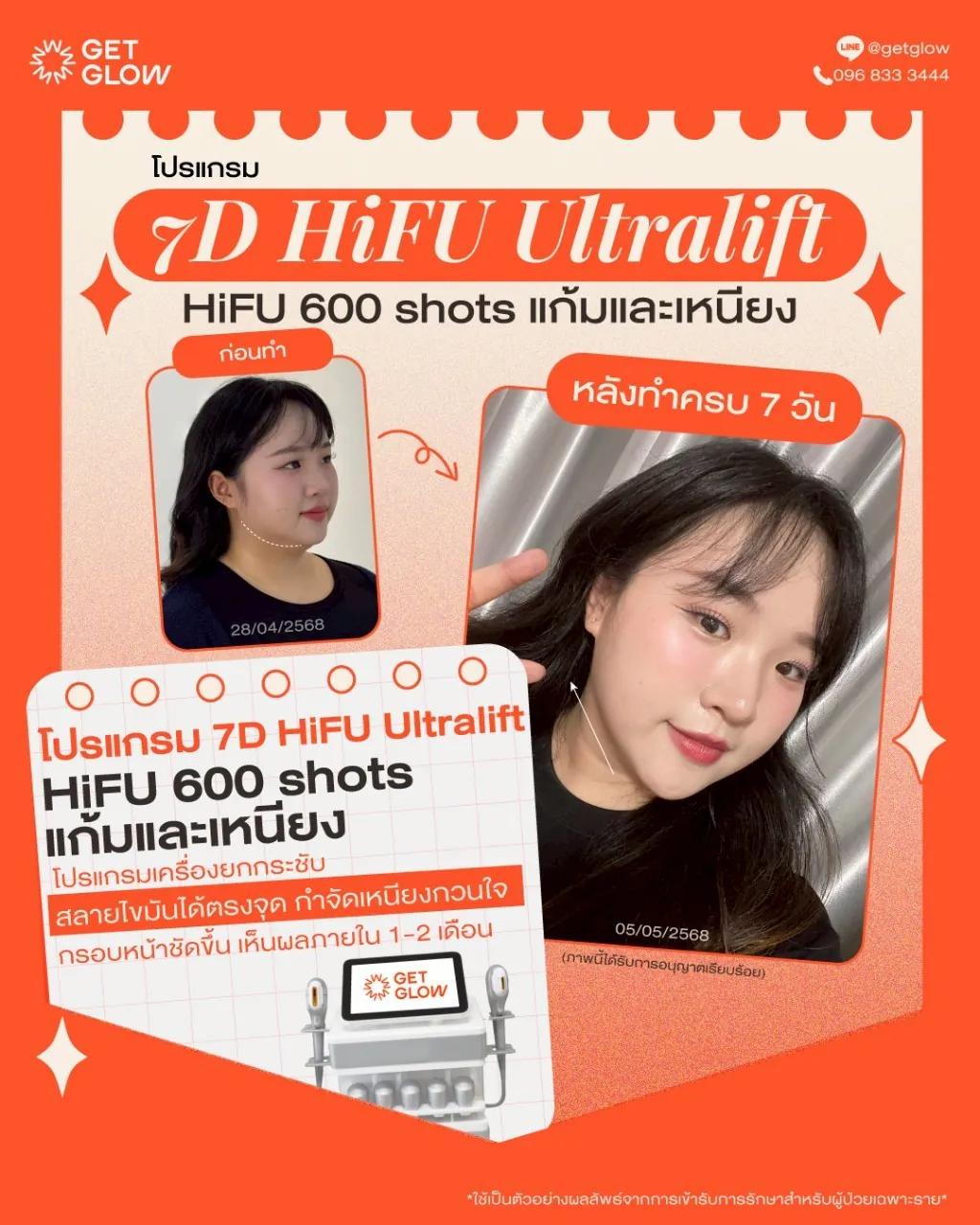 รีวิวจริง 7D HIFU — 600 shots · แก้มและเหนียง · หลังทำ 7 วัน ที่ GETGLOW Clinic สยามสแควร์วัน