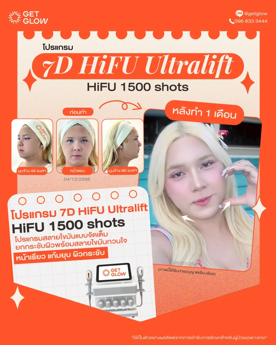 รีวิวจริง 7D HIFU — 1500 shots · สลายไขมันจัดเต็ม · หลังทำ 1 เดือน ที่ GETGLOW Clinic สยามสแควร์วัน