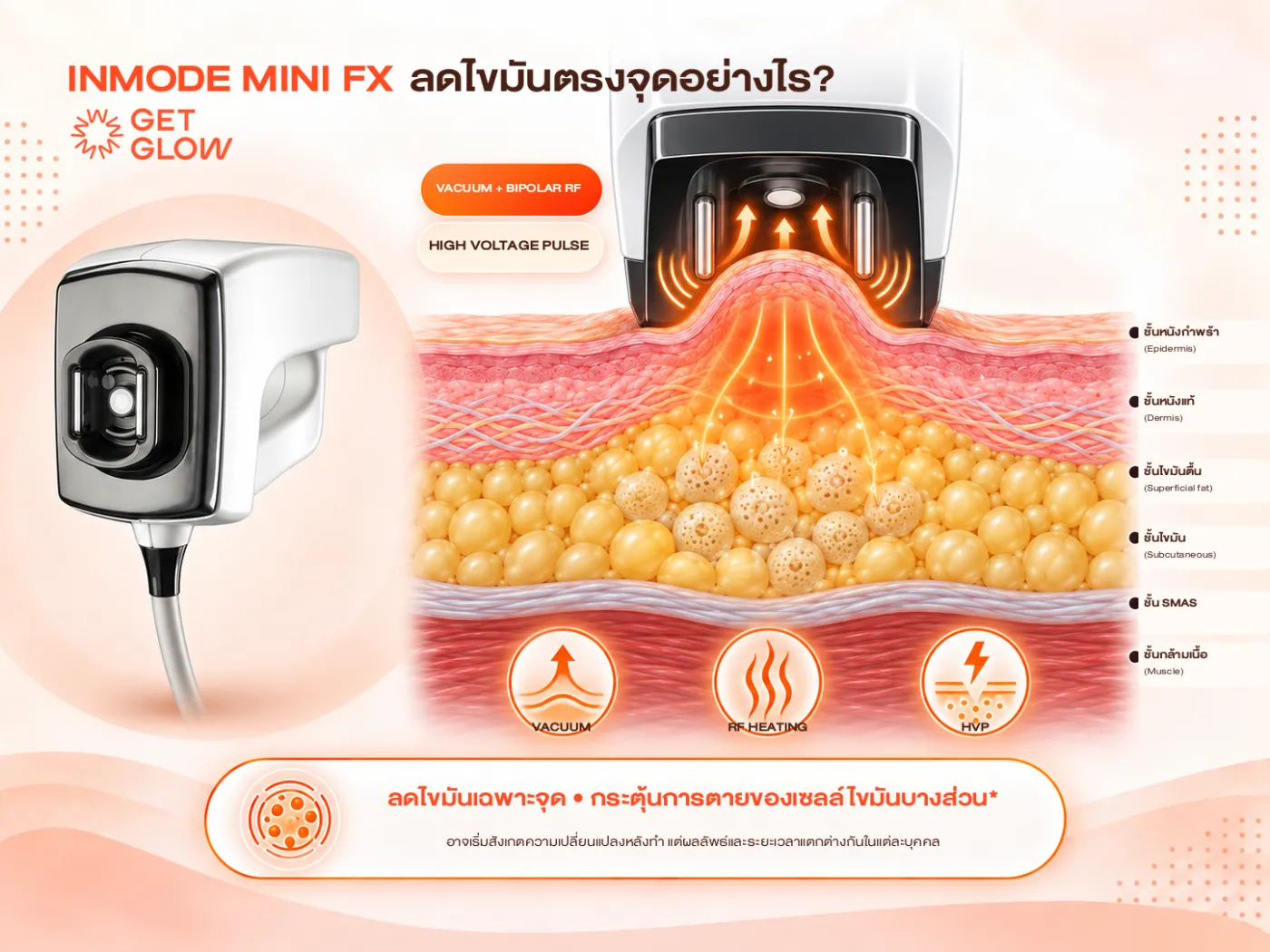 Inmode Mini FX ลดไขมันตรงจุดอย่างไร — Vacuum ดูดยกผิว, Bipolar RF ให้ความร้อนชั้นไขมัน และ High Voltage Pulse กระตุ้นเซลล์ไขมันบางส่วน