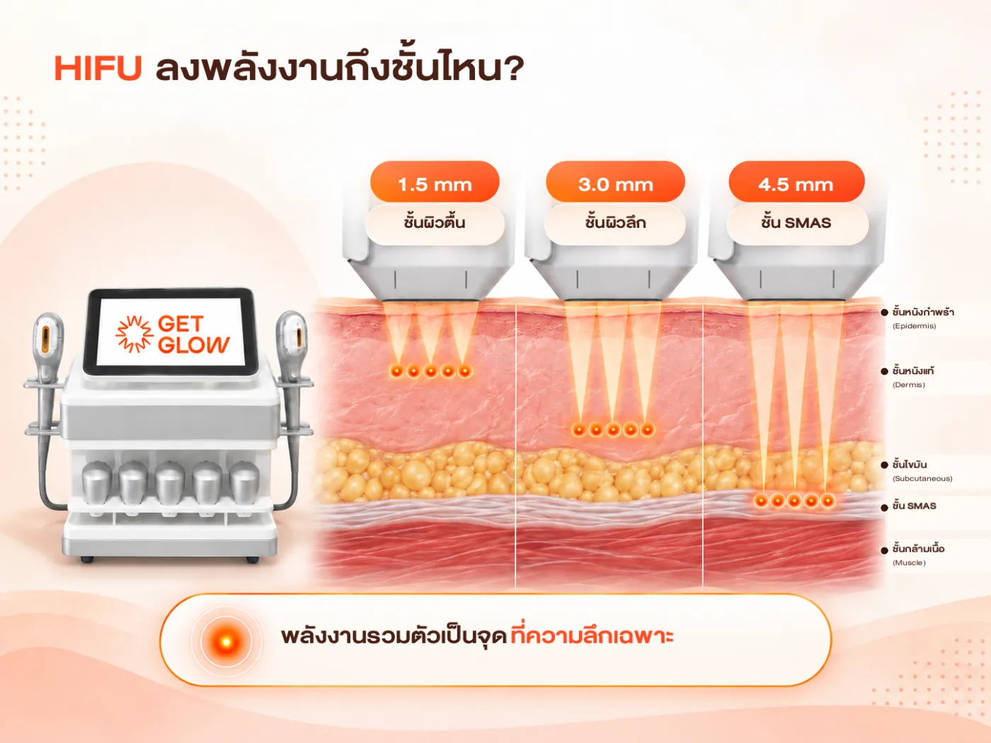 อินโฟกราฟิก HIFU ลงพลังงานถึงชั้นไหน — หัว 1.5 mm ชั้นผิวตื้น, 3.0 mm ชั้นผิวลึก และ 4.5 mm ชั้น SMAS