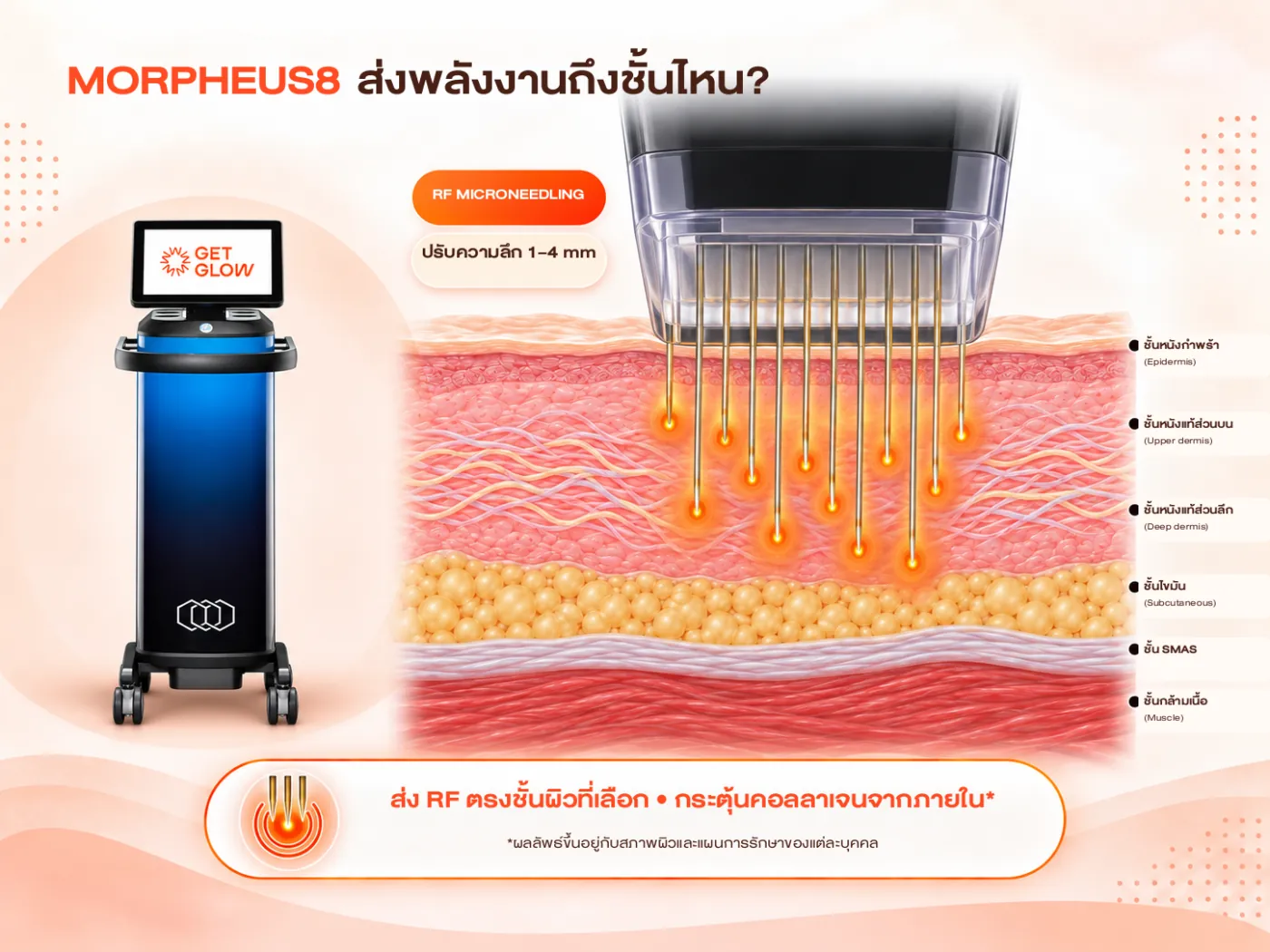 อินโฟกราฟิก MORPHEUS8 ส่งพลังงานถึงชั้นไหน — RF Microneedling ปรับความลึกเข็มได้ 1–4 mm