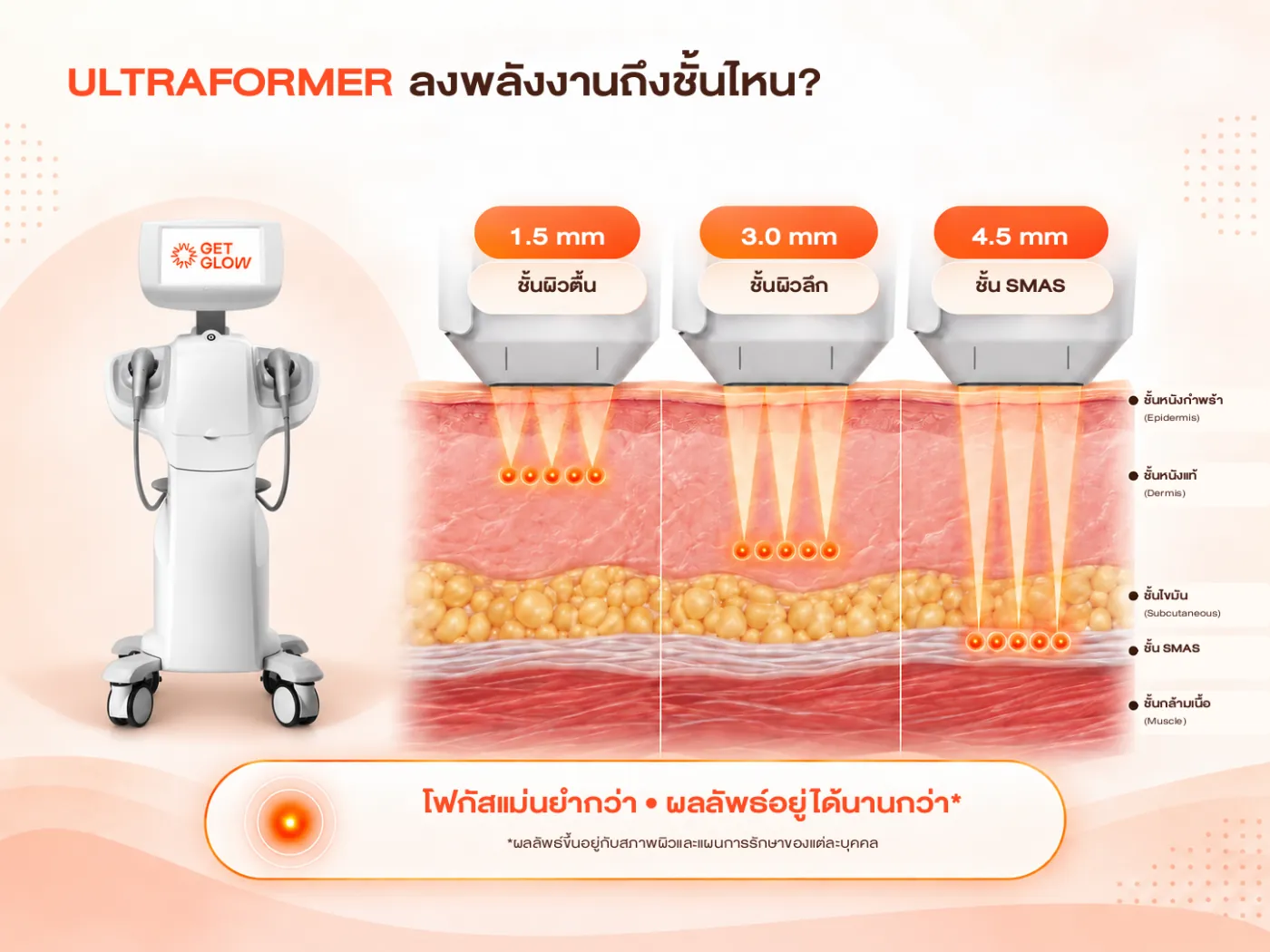 อินโฟกราฟิก ULTRAFORMER ลงพลังงานถึงชั้นไหน — หัว 1.5 mm, 3.0 mm และ 4.5 mm ชั้น SMAS