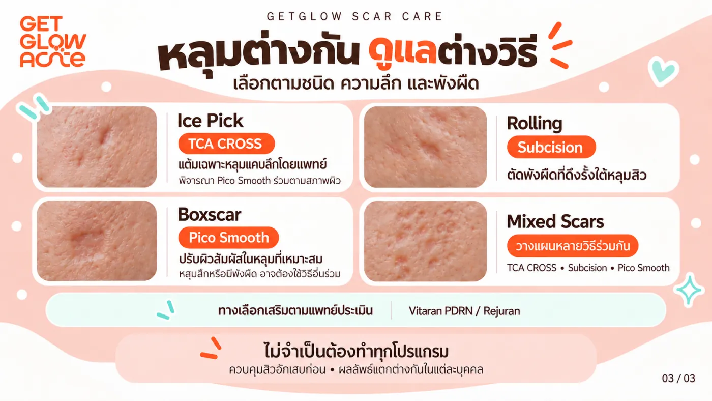 หลุมต่างกันดูแลต่างวิธี — Ice Pick ใช้ TCA CROSS, Rolling ใช้ Subcision, Boxscar ใช้ Pico Smooth และหลุมผสมวางแผนหลายวิธีร่วมกัน