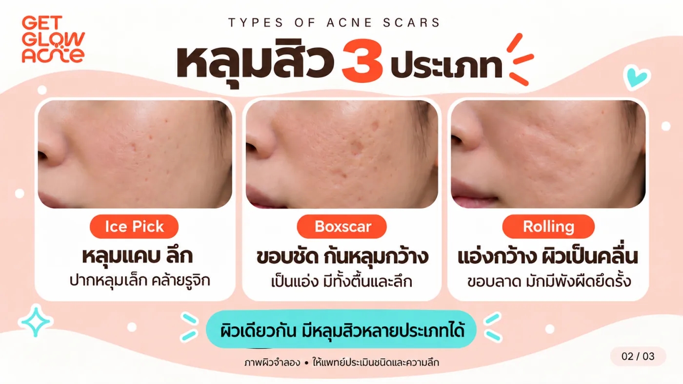 หลุมสิว 3 ประเภท — Ice Pick หลุมแคบลึก, Boxscar ขอบชัดก้นหลุมกว้าง และ Rolling แอ่งกว้างผิวเป็นคลื่น