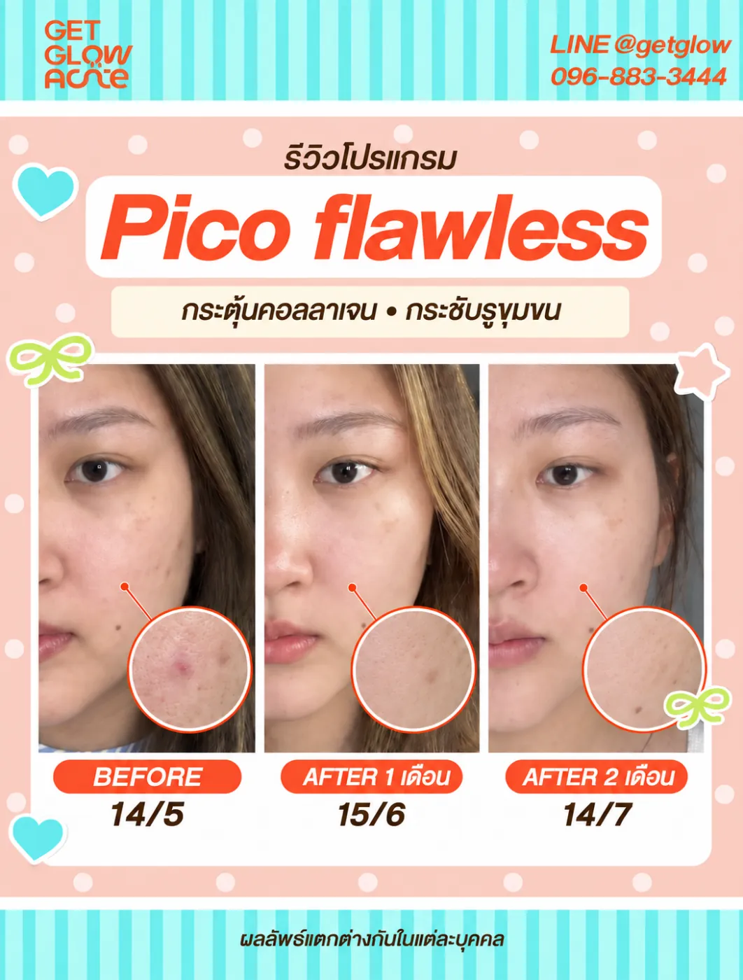 รีวิว Pico Flawless ก่อนทำ 14/5 หลังทำ 1 เดือน 15/6 และหลังทำ 2 เดือน 14/7