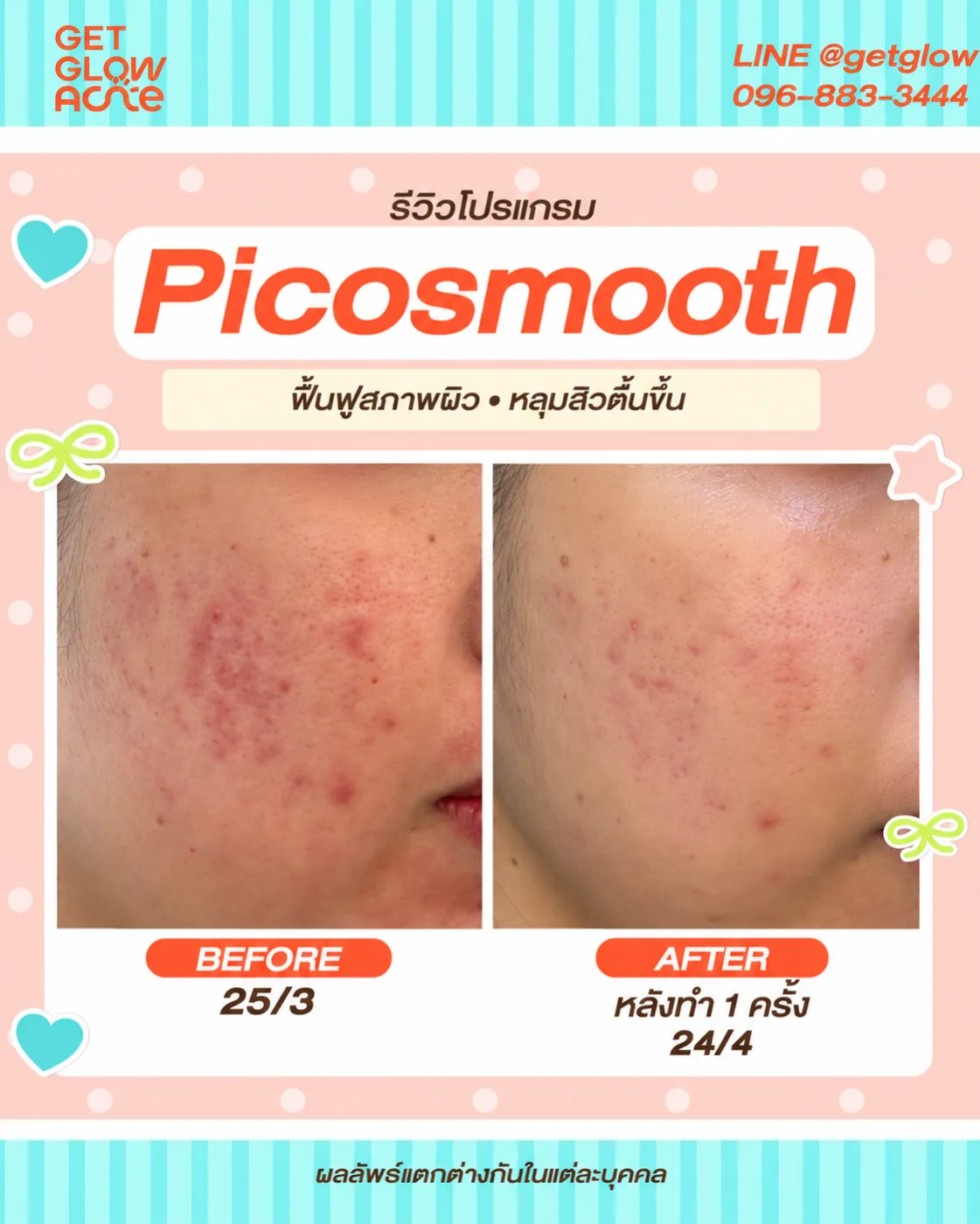รีวิว Picosmooth ก่อนทำ 25/3 และหลังทำ 1 ครั้ง วันที่ 24/4