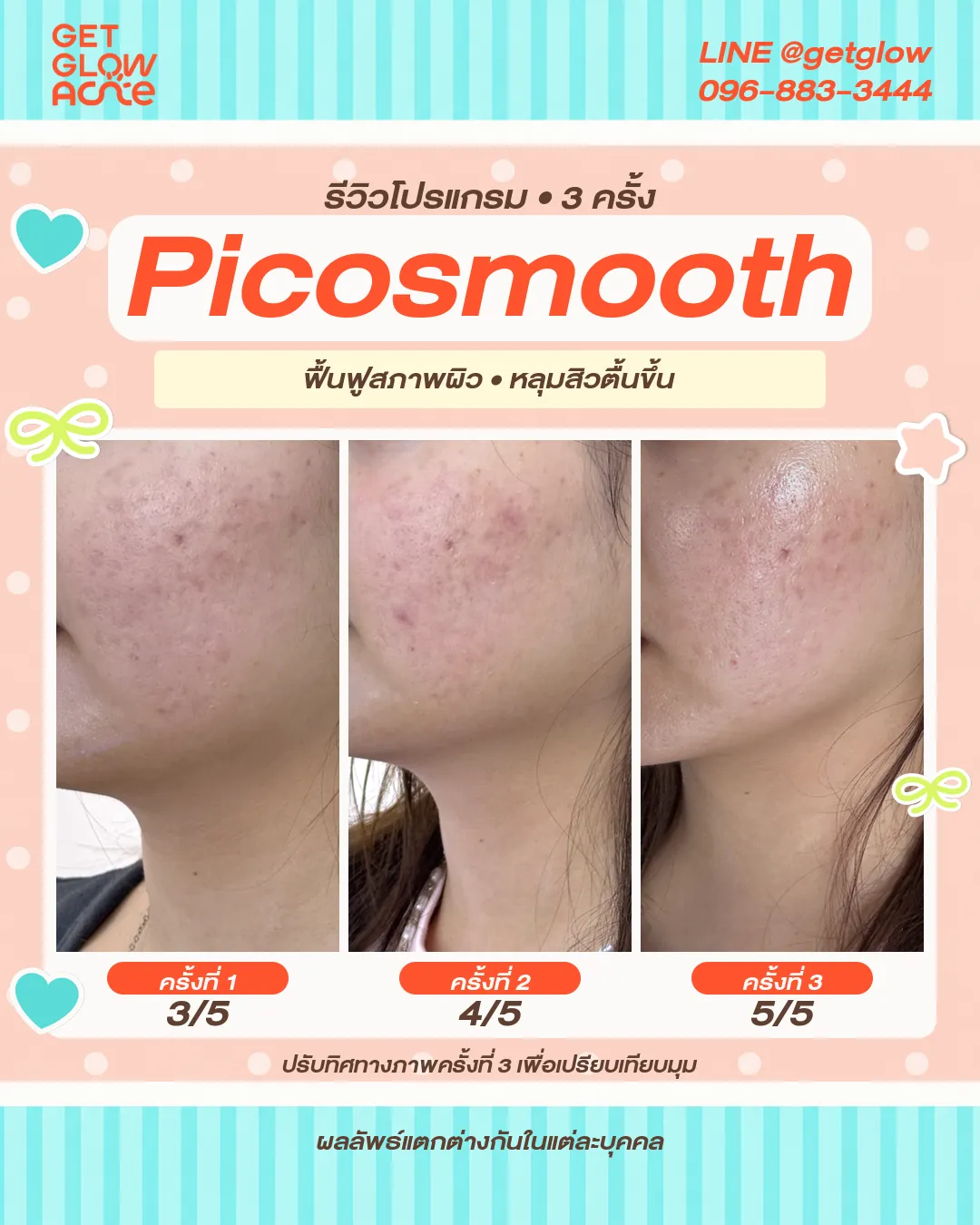 รีวิว Picosmooth เปรียบเทียบผิวบริเวณแก้มหลังทำครั้งที่ 1 ถึงครั้งที่ 3