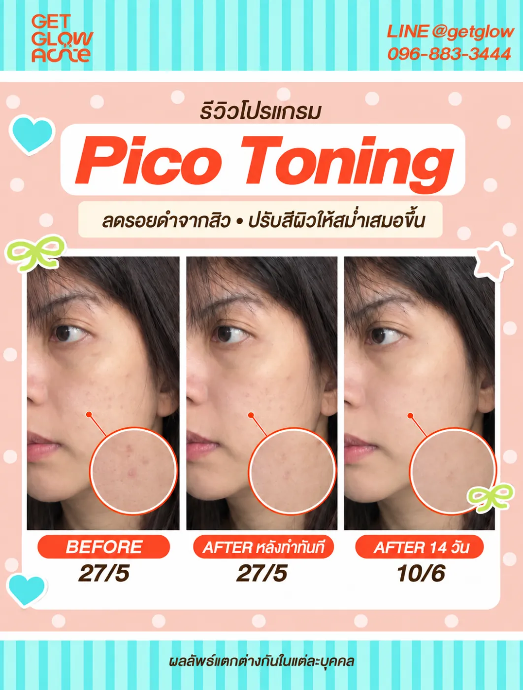 รีวิว Pico Toning ก่อนทำ 27/5 หลังทำทันที และหลังทำ 14 วัน วันที่ 10/6