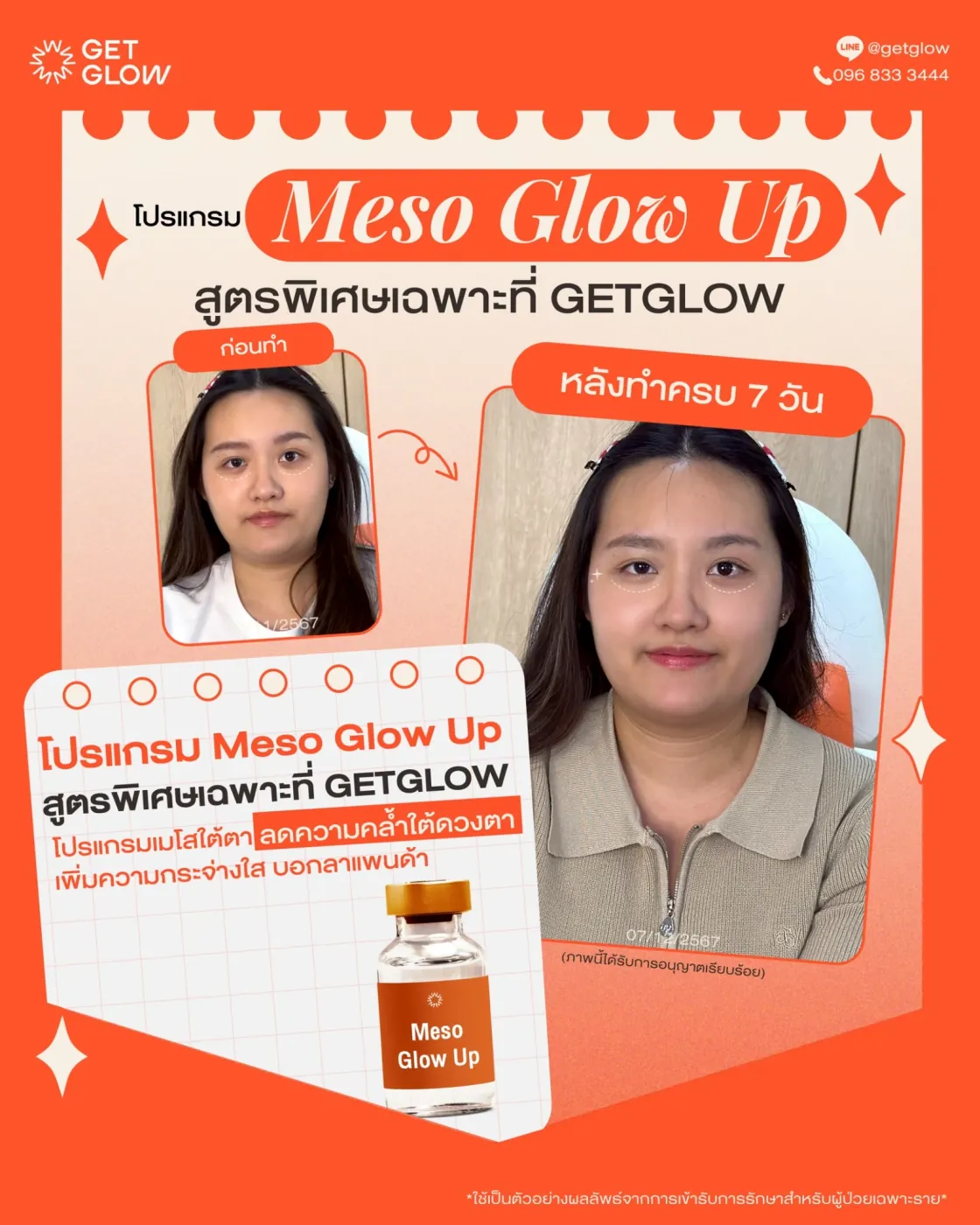 รีวิว Meso Glow Up เคสที่ 1 — เปรียบเทียบก่อนทำและหลังทำครบ 7 วัน