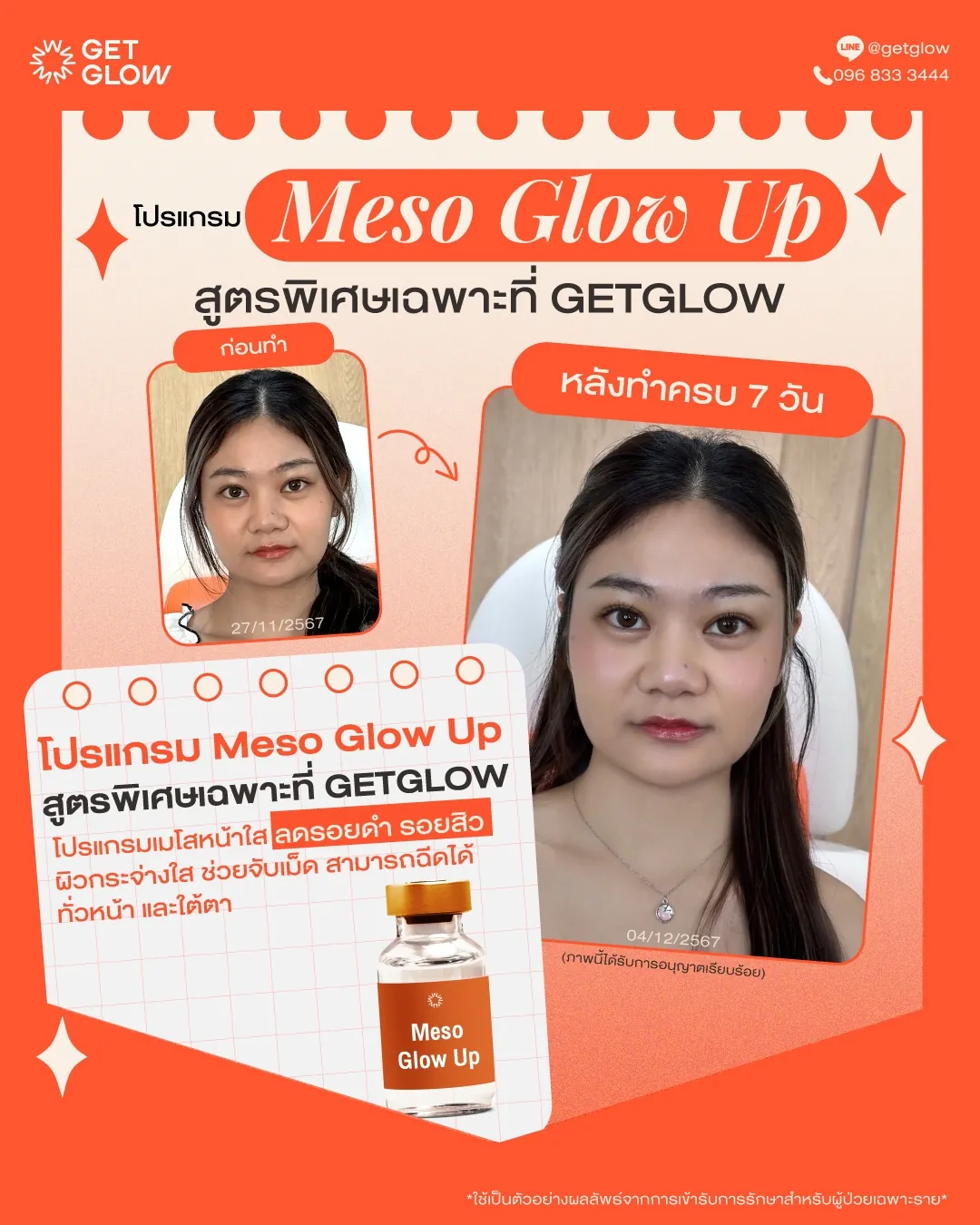 รีวิว Meso Glow Up เคสที่ 2 — ดูแลรอยดำ รอยสิว ผิวกระจ่างใสขึ้น
