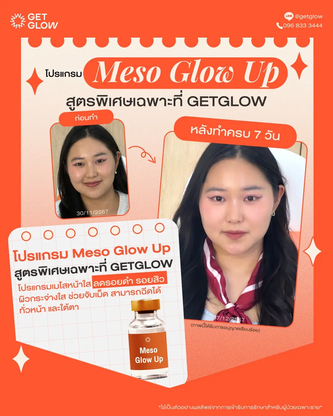 รีวิว Meso Glow Up เคสที่ 3 — เปรียบเทียบก่อนทำและหลังทำครบ 7 วัน
