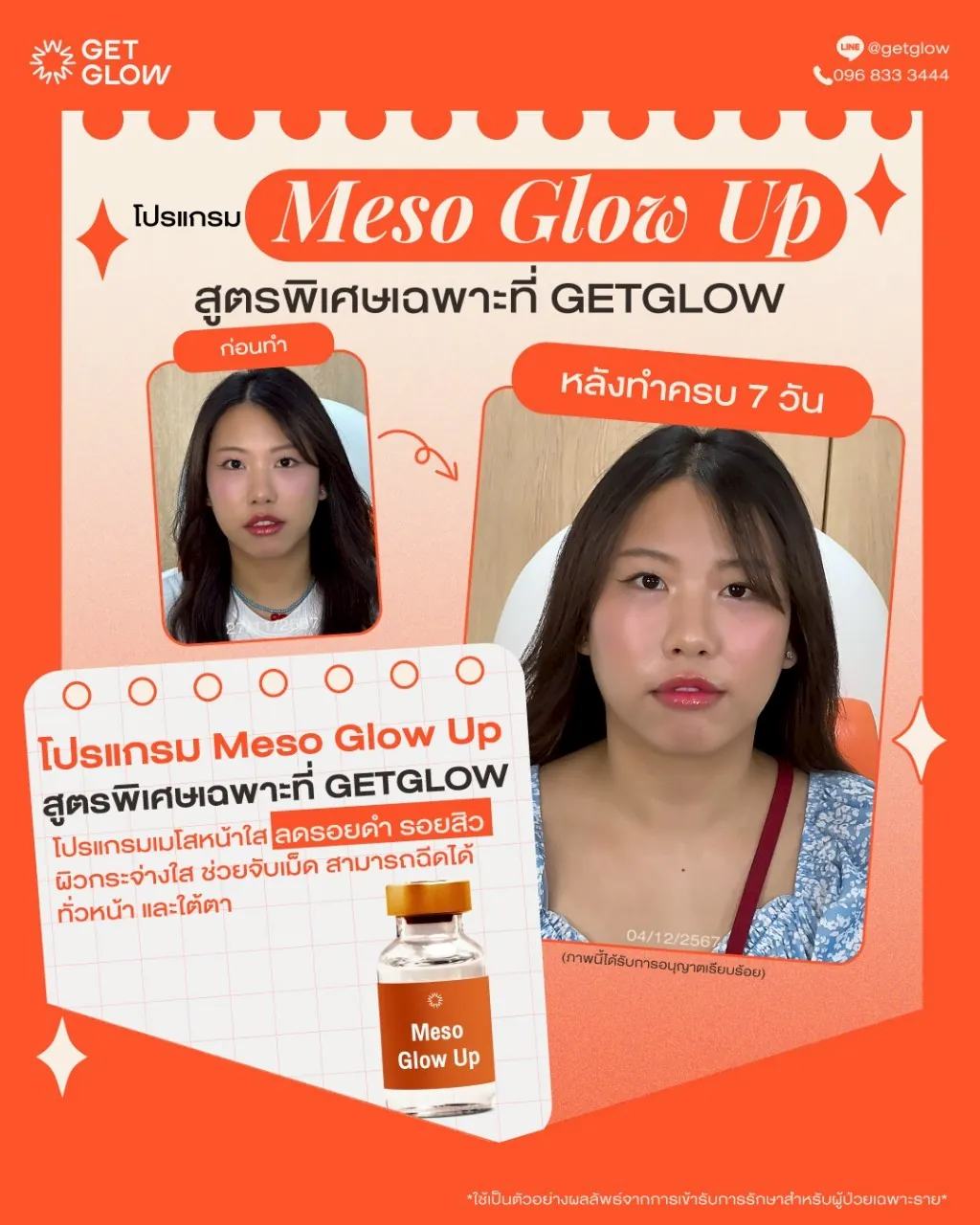 รีวิว Meso Glow Up เคสที่ 4 — เปรียบเทียบก่อนทำและหลังทำครบ 7 วัน