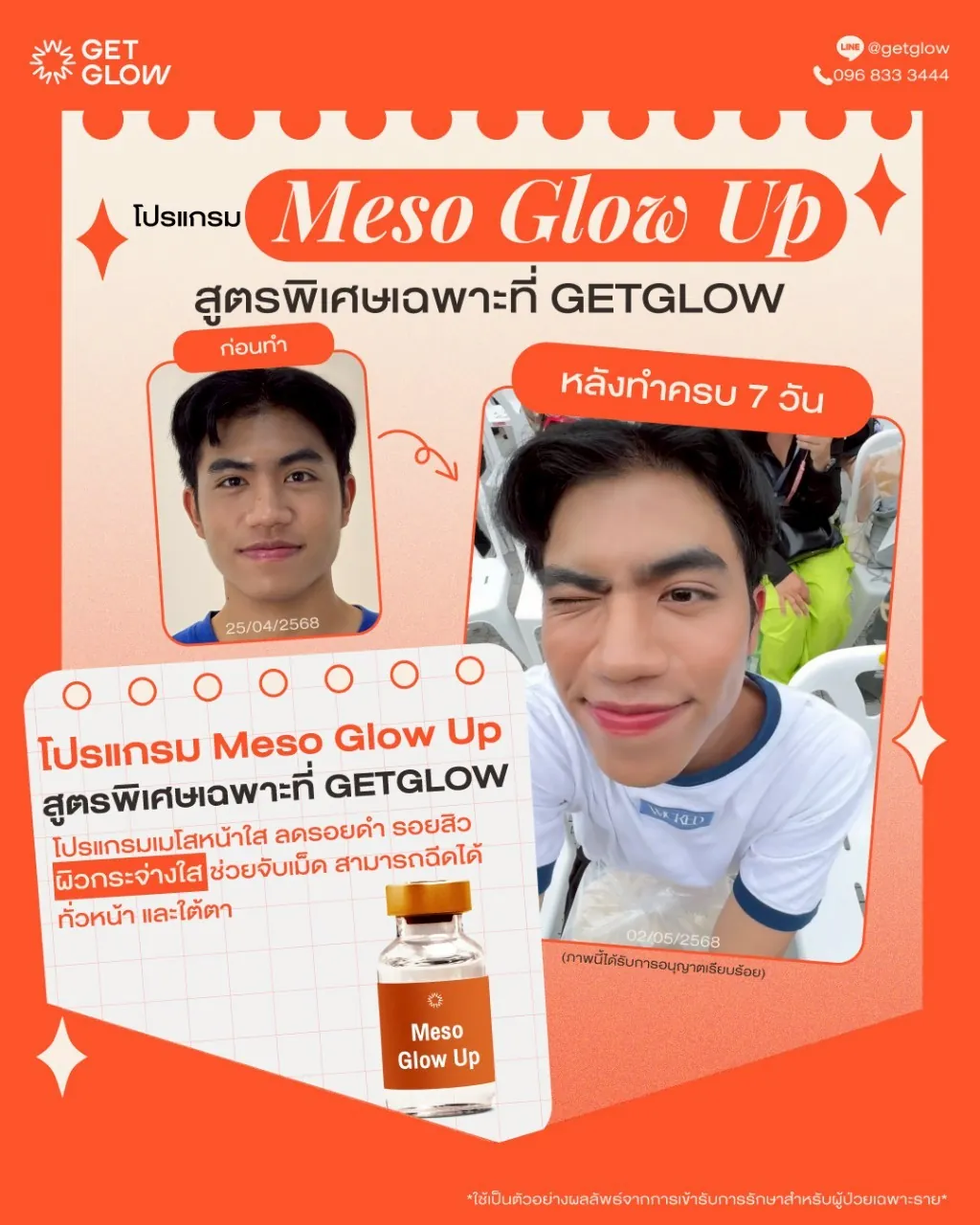 รีวิว Meso Glow Up เคสที่ 5 — เปรียบเทียบก่อนทำและหลังทำครบ 7 วัน