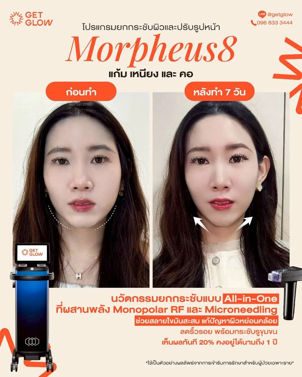 รีวิวจริง Morpheus8 — RF Microneedling · ผิวสัมผัสและความกระชับ ที่ GETGLOW Clinic สยามสแควร์วัน