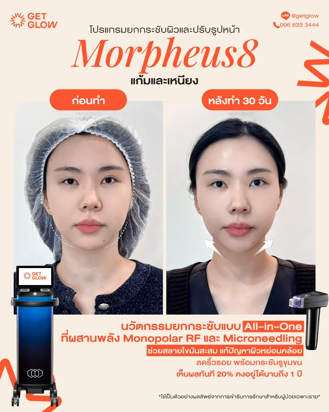 รีวิวจริง Morpheus8 — RF Microneedling · ผิวสัมผัสและความกระชับ ที่ GETGLOW Clinic สยามสแควร์วัน
