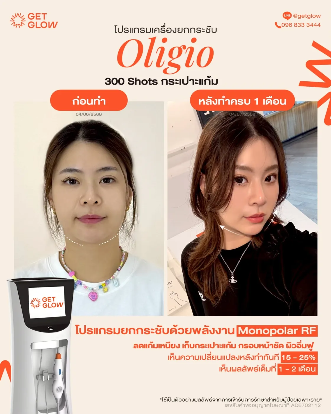 รีวิวจริง Oligio — RF ยกกระชับ ผิวเรียบกระชับขึ้น ที่ GETGLOW Clinic สยามสแควร์วัน