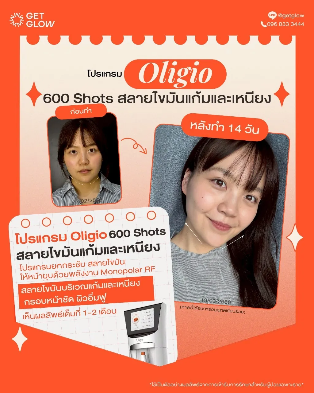 รีวิวจริง Oligio — RF ยกกระชับ ผิวเรียบกระชับขึ้น ที่ GETGLOW Clinic สยามสแควร์วัน