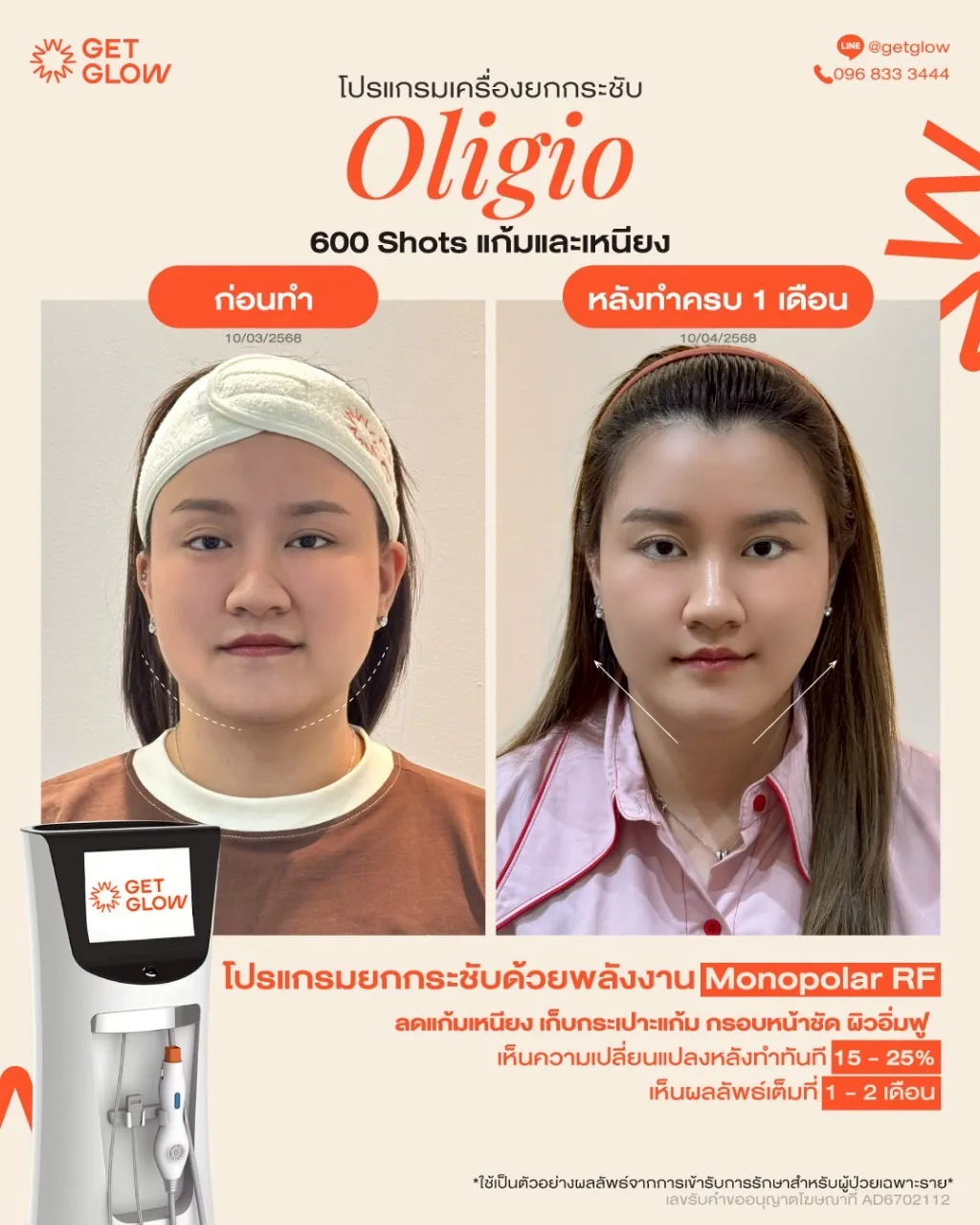 รีวิวจริง Oligio — RF ยกกระชับ ผิวเรียบกระชับขึ้น ที่ GETGLOW Clinic สยามสแควร์วัน