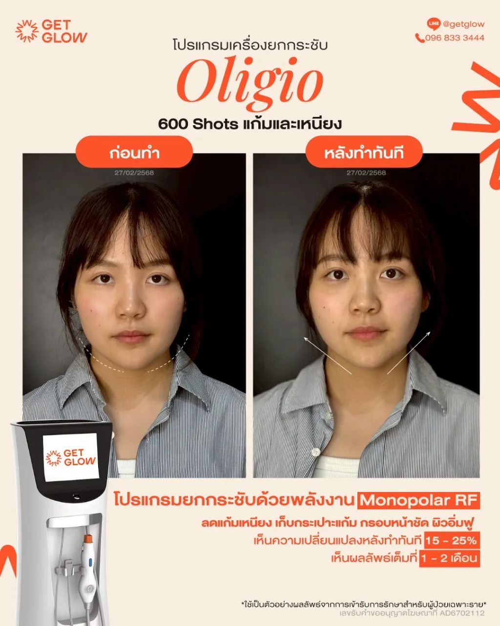 รีวิวจริง Oligio — RF ยกกระชับ ผิวเรียบกระชับขึ้น ที่ GETGLOW Clinic สยามสแควร์วัน