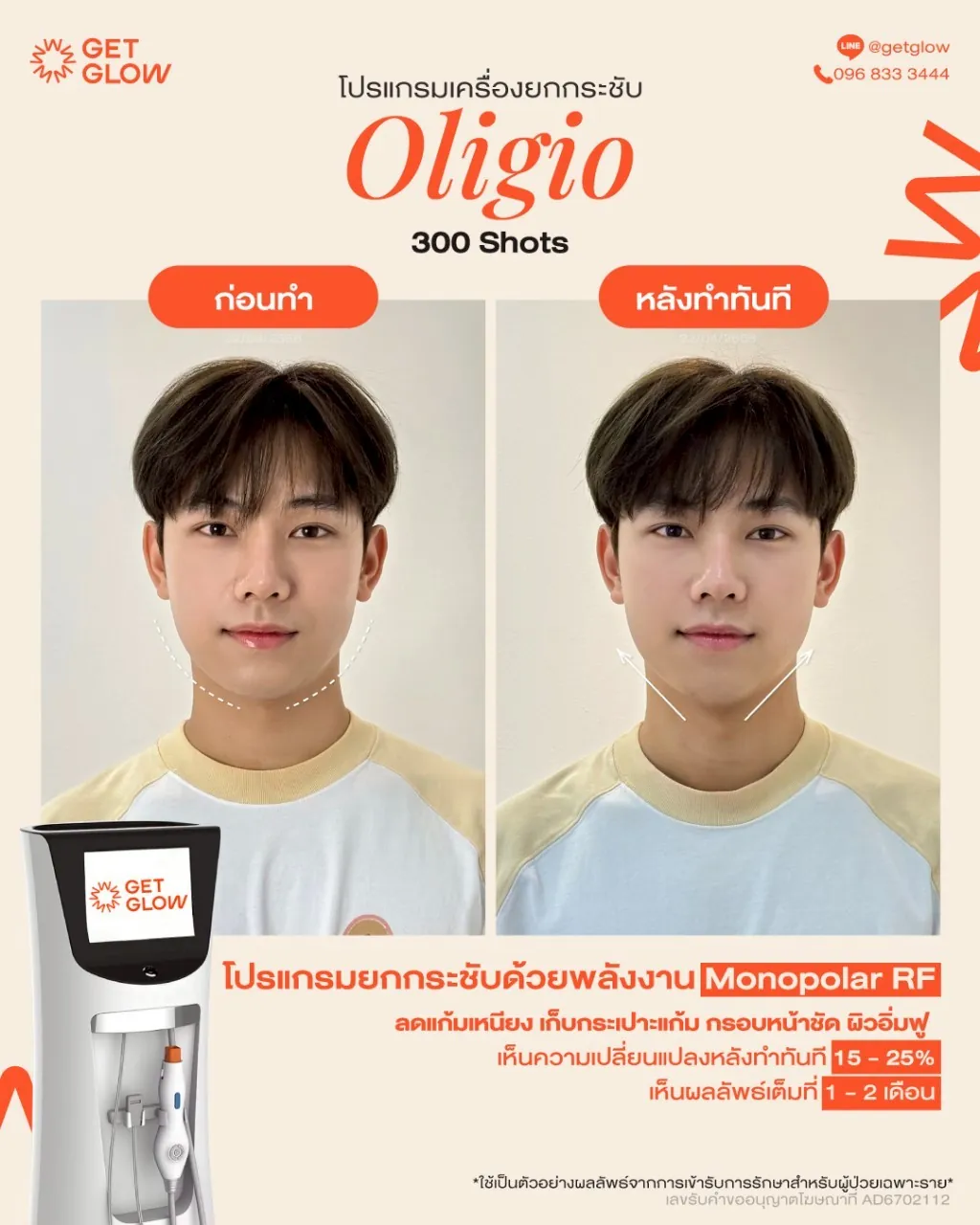 รีวิวจริง Oligio — RF ยกกระชับ ผิวเรียบกระชับขึ้น ที่ GETGLOW Clinic สยามสแควร์วัน