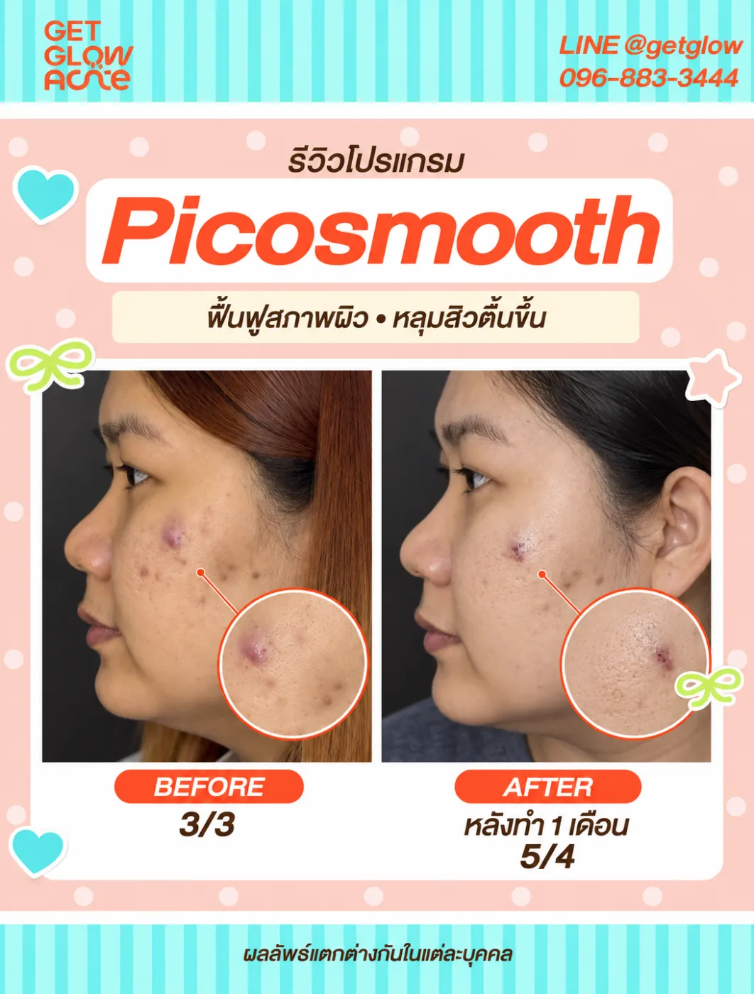 รีวิว Pico Smooth — เปรียบเทียบก่อนทำและหลังทำ 1 เดือน พร้อมภาพขยายบริเวณแก้ม