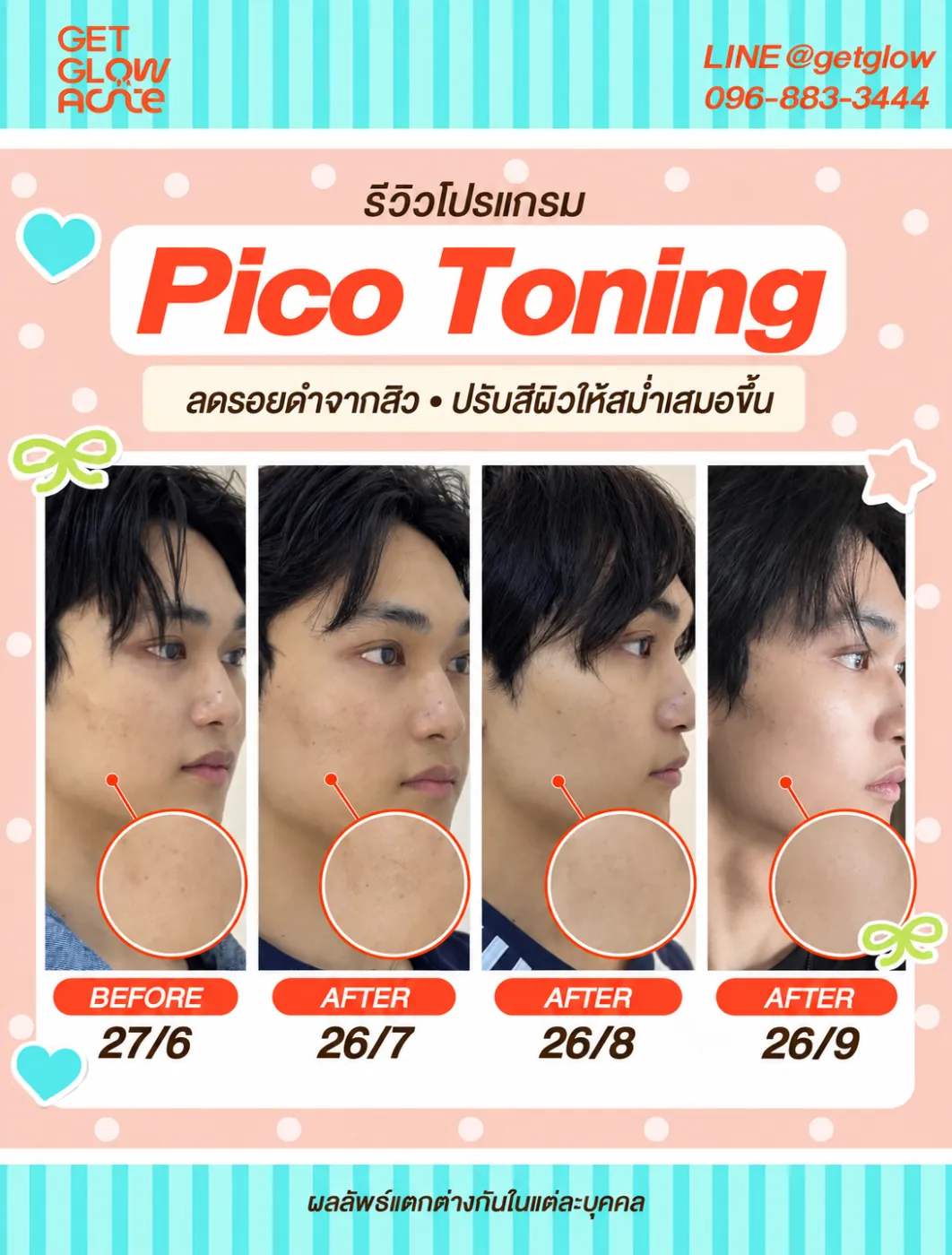 รีวิว Pico Toning — ลดรอยดำจากสิว ปรับสีผิวให้สม่ำเสมอขึ้น เปรียบเทียบ 4 ช่วงเวลา