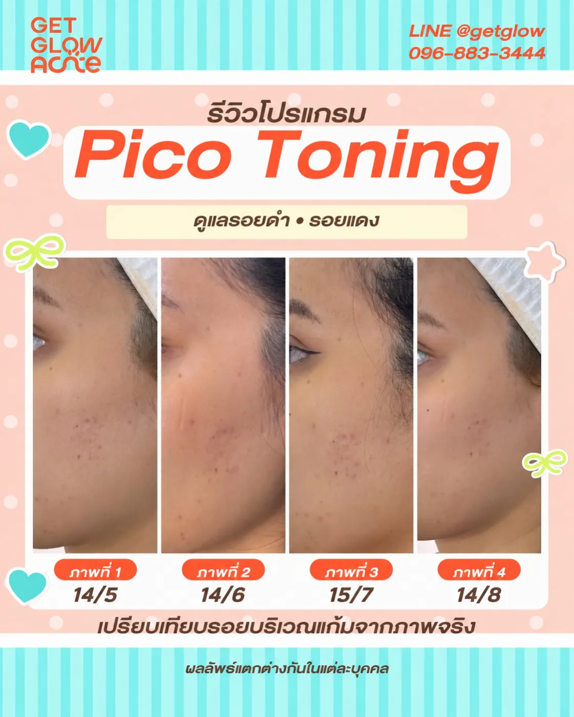 รีวิว Pico Toning — ดูแลรอยดำและรอยแดงบริเวณแก้ม เปรียบเทียบ 4 ช่วงเวลา