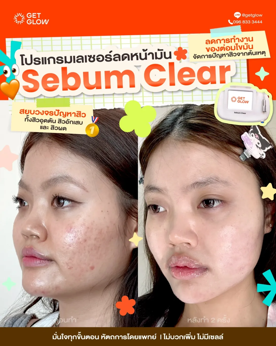 รีวิว Sebum Clear — เปรียบเทียบก่อนทำและหลังทำ 2 ครั้ง ดูแลความมันและสิวอักเสบ