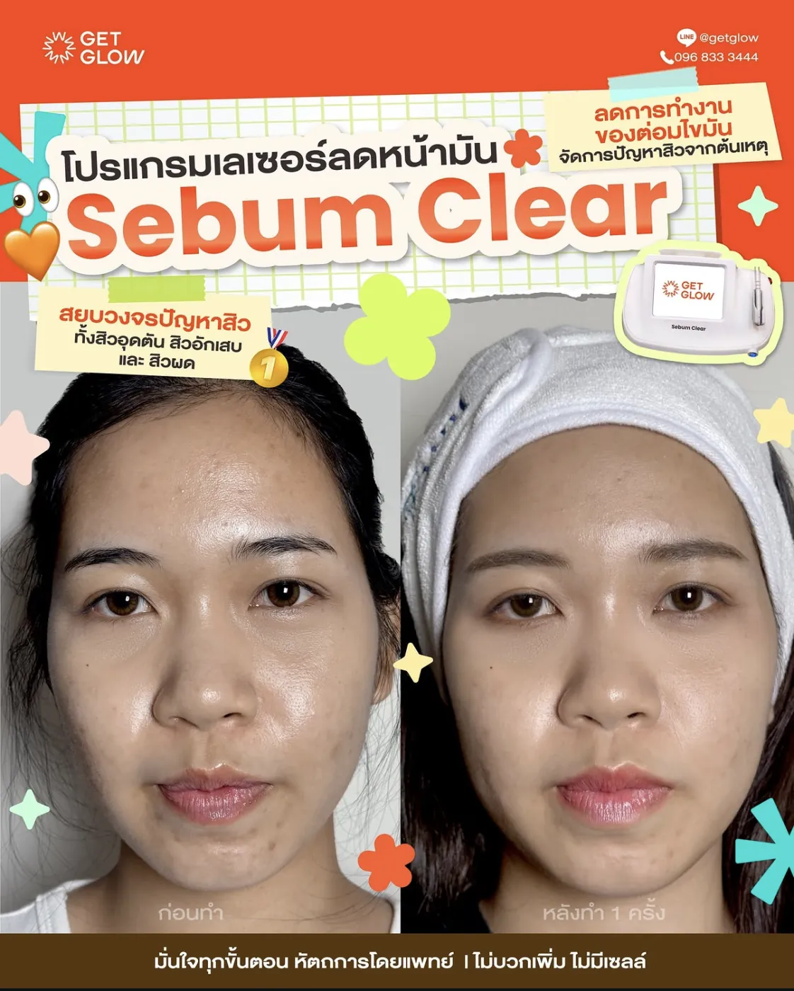 รีวิว Sebum Clear — เปรียบเทียบก่อนทำและหลังทำ 1 ครั้ง ผิวดูมันน้อยลง