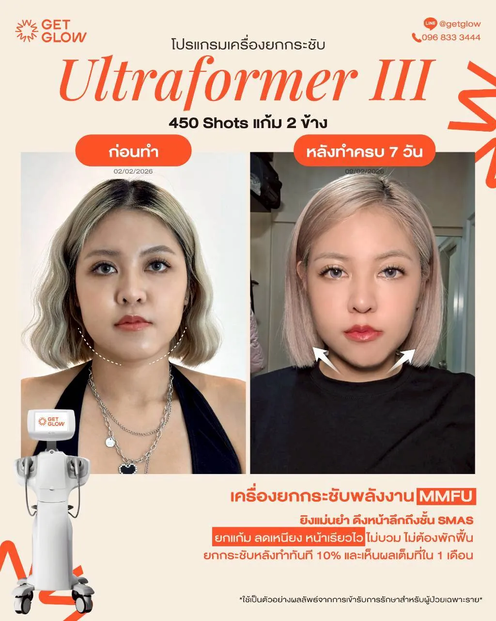 รีวิวจริง Ultraformer III — ยกกระชับกรอบหน้าและเหนียง ที่ GETGLOW Clinic สยามสแควร์วัน