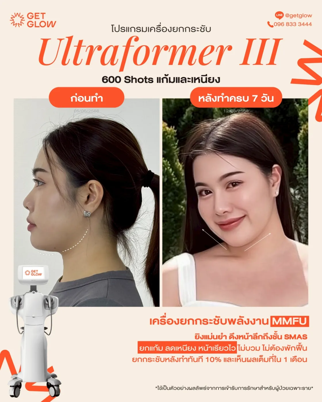 รีวิวจริง Ultraformer III — ยกกระชับกรอบหน้าและเหนียง ที่ GETGLOW Clinic สยามสแควร์วัน