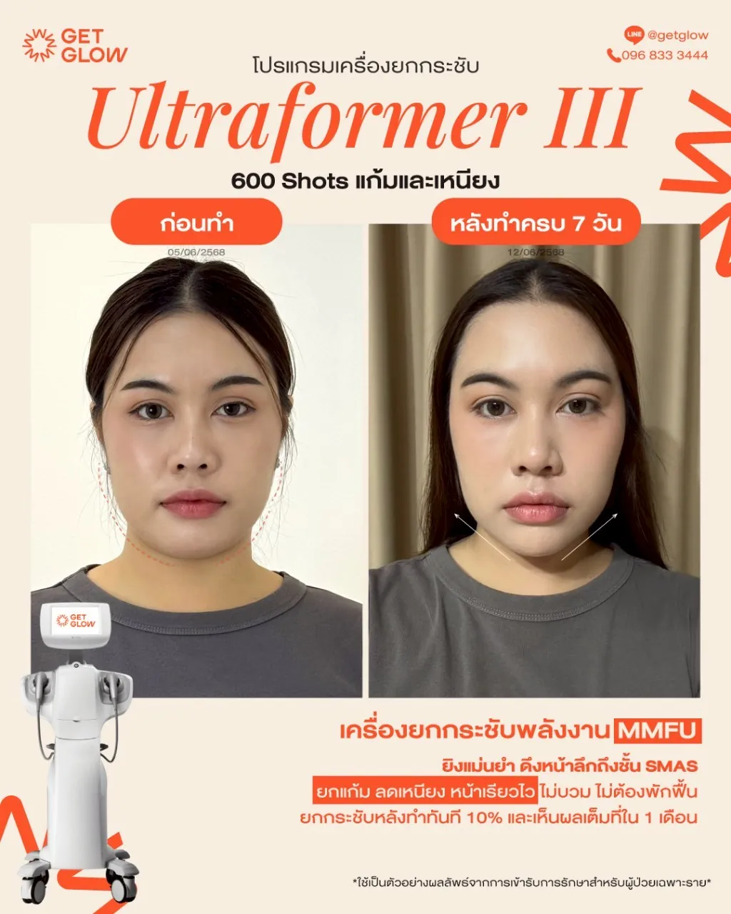 รีวิวจริง Ultraformer III — ยกกระชับกรอบหน้าและเหนียง ที่ GETGLOW Clinic สยามสแควร์วัน