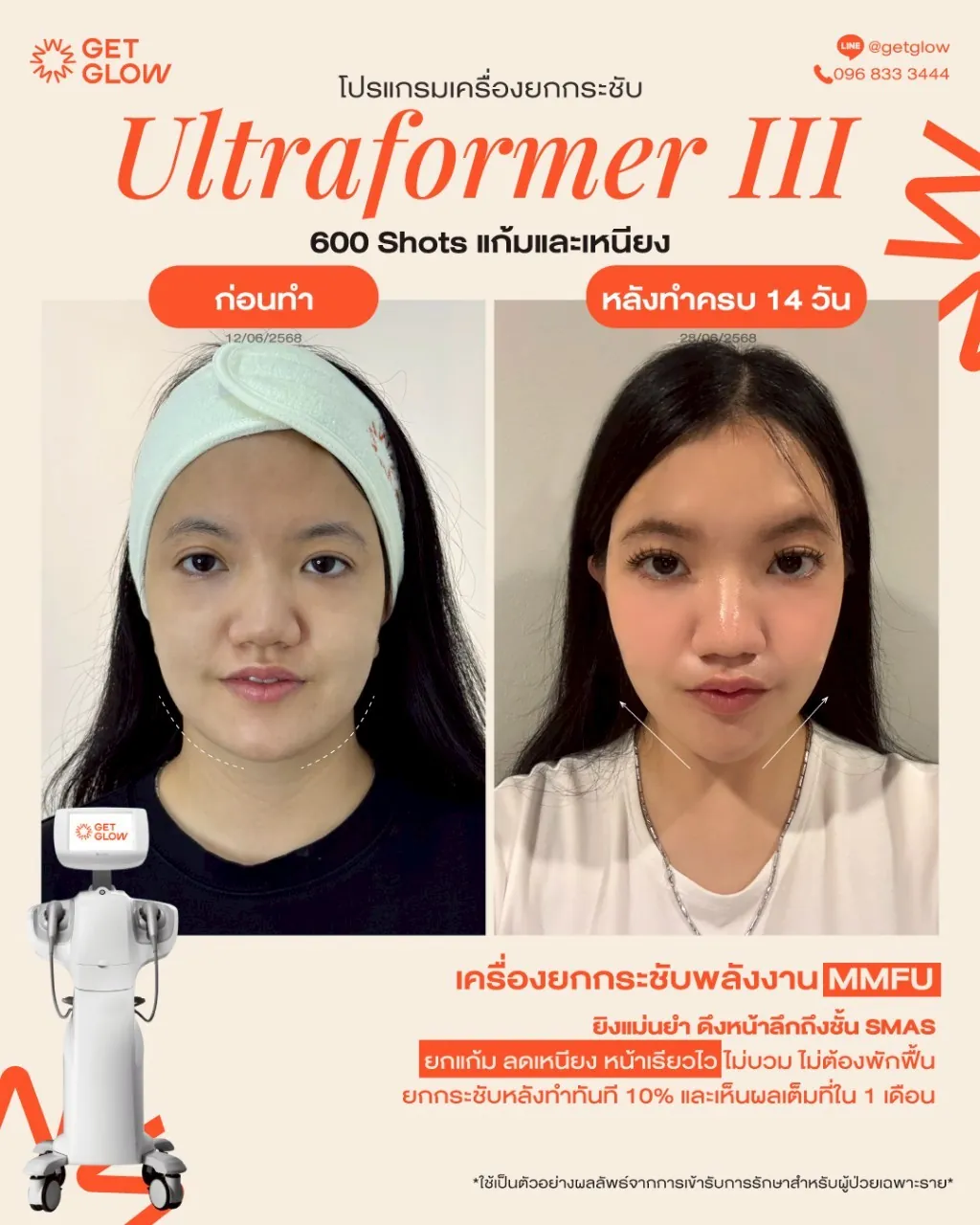 รีวิวจริง Ultraformer III — ยกกระชับกรอบหน้าและเหนียง ที่ GETGLOW Clinic สยามสแควร์วัน