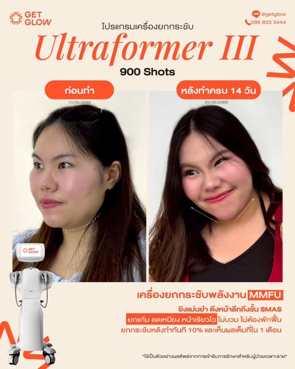 รีวิวจริง Ultraformer III — ยกกระชับกรอบหน้าและเหนียง ที่ GETGLOW Clinic สยามสแควร์วัน