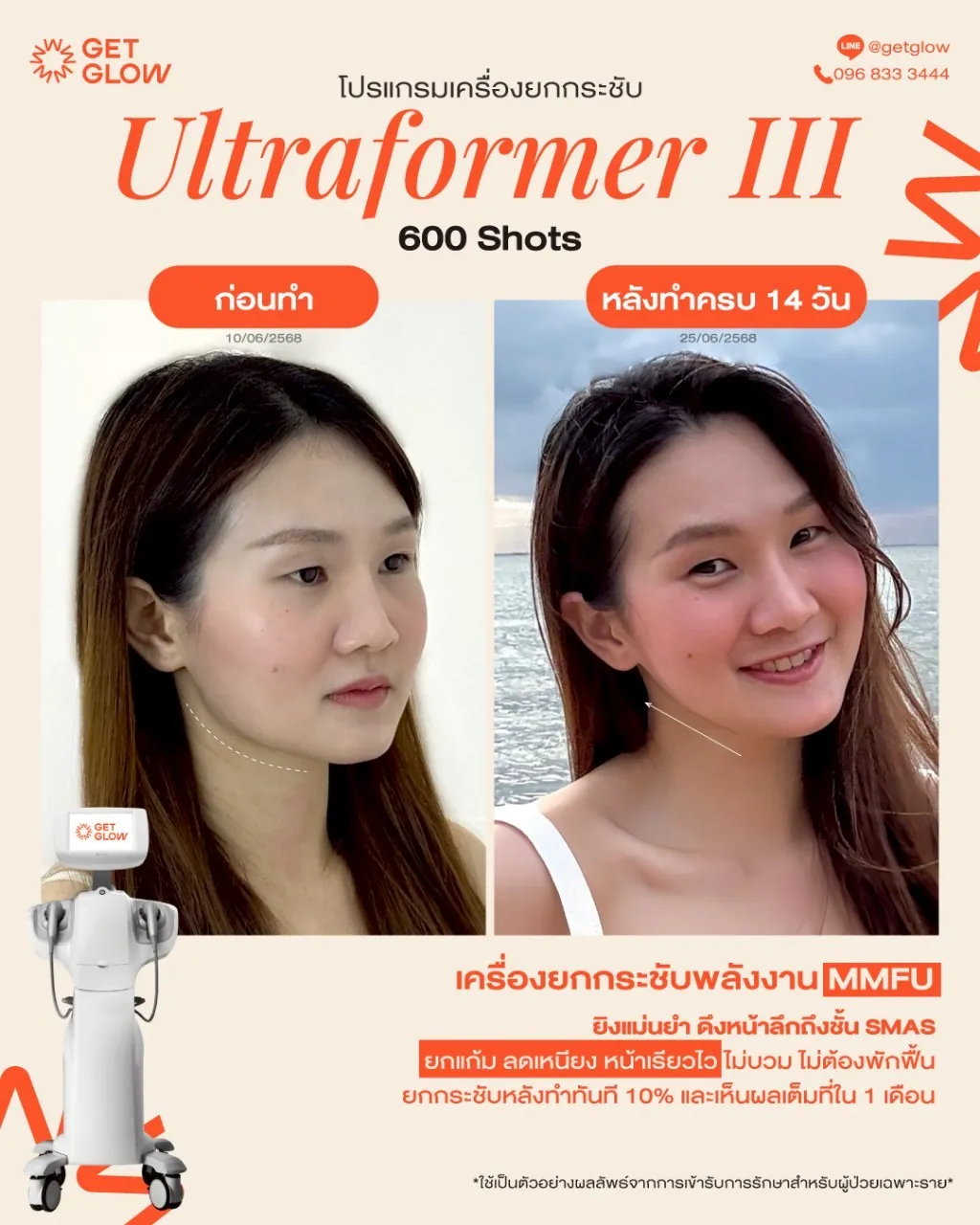 รีวิวจริง Ultraformer III — ยกกระชับกรอบหน้าและเหนียง ที่ GETGLOW Clinic สยามสแควร์วัน