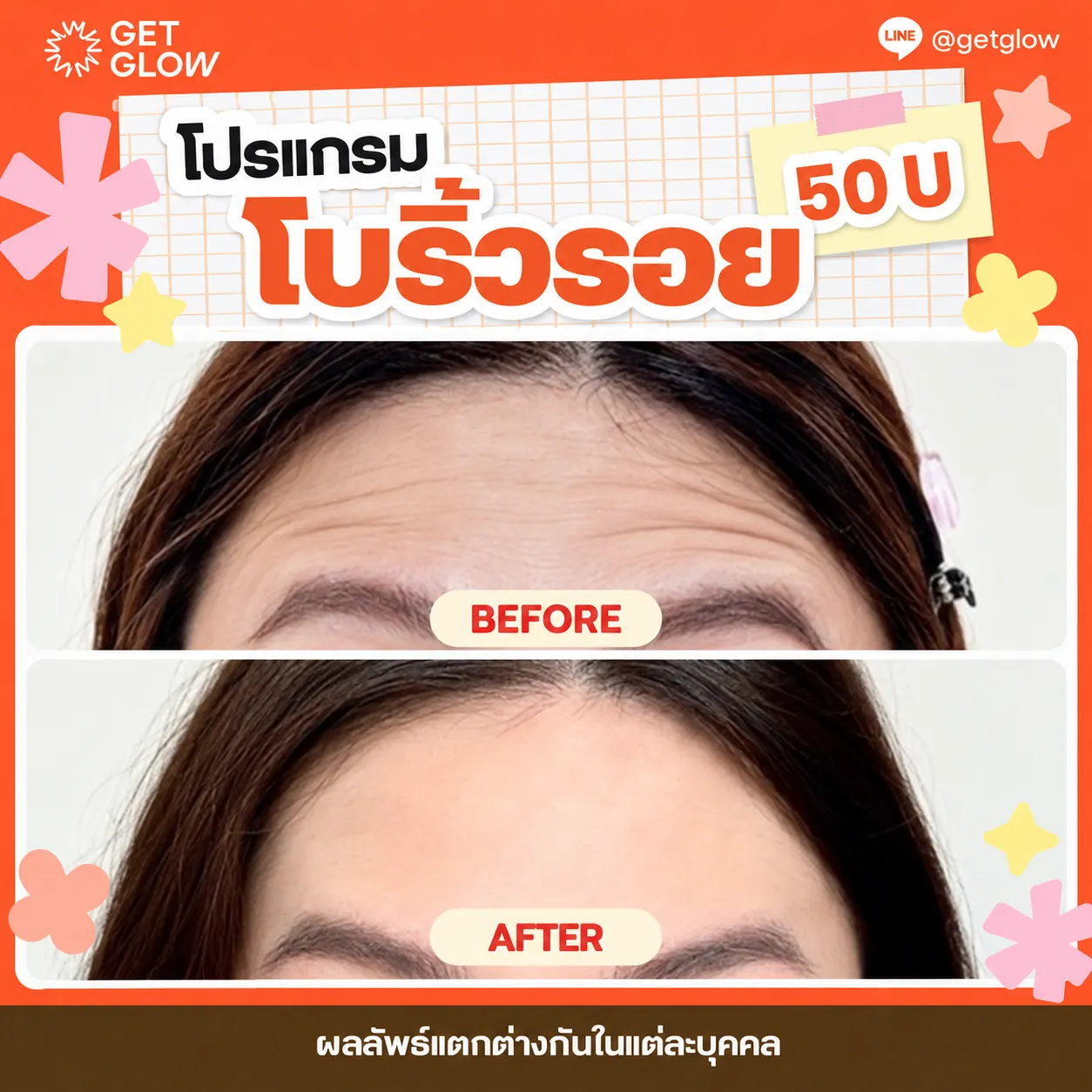รีวิวจริง โบท็อกซ์ — ริ้วรอยหน้าผาก ที่ GETGLOW Clinic สยามสแควร์วัน