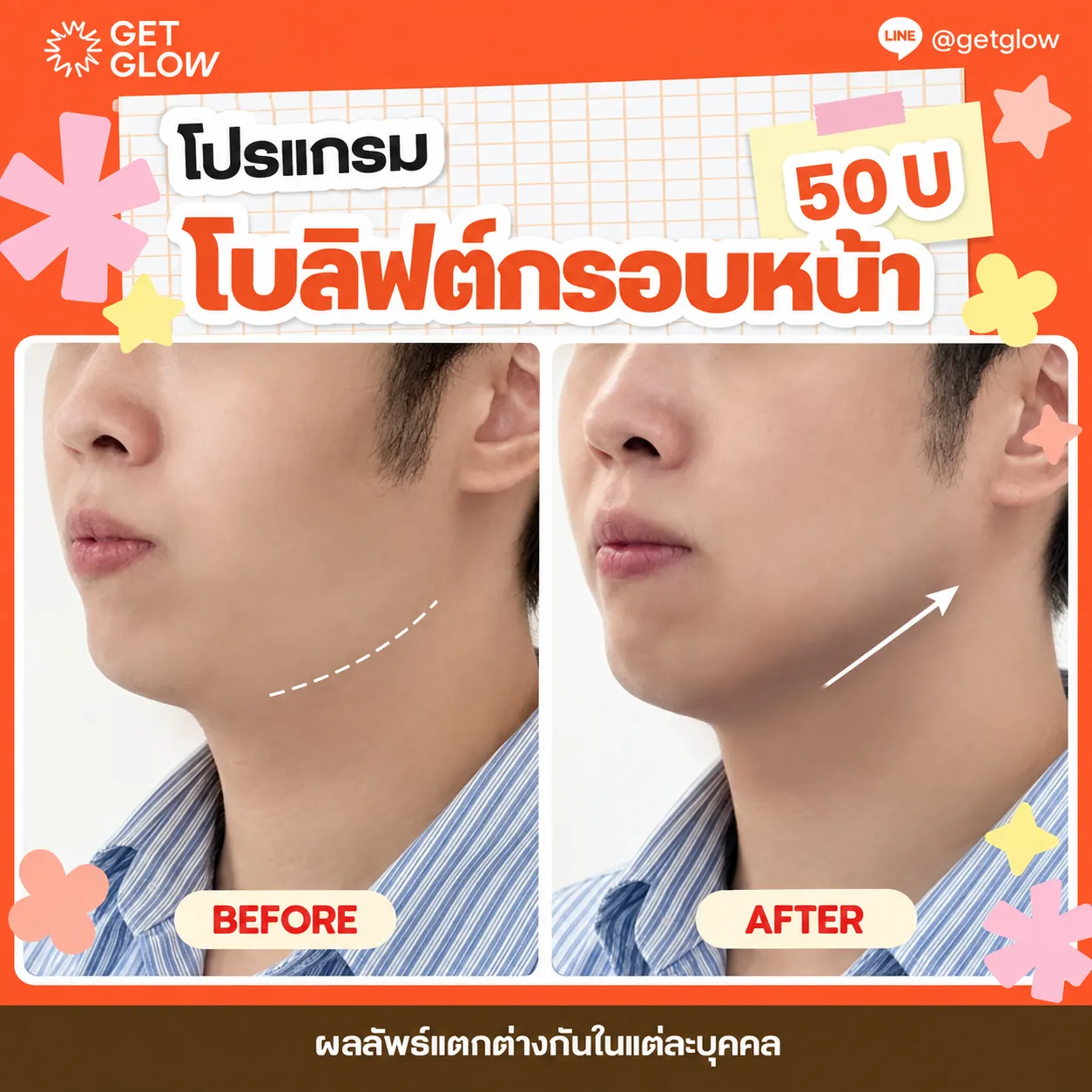 รีวิวจริง โบท็อกซ์ — ลิฟต์กรอบหน้า ที่ GETGLOW Clinic สยามสแควร์วัน