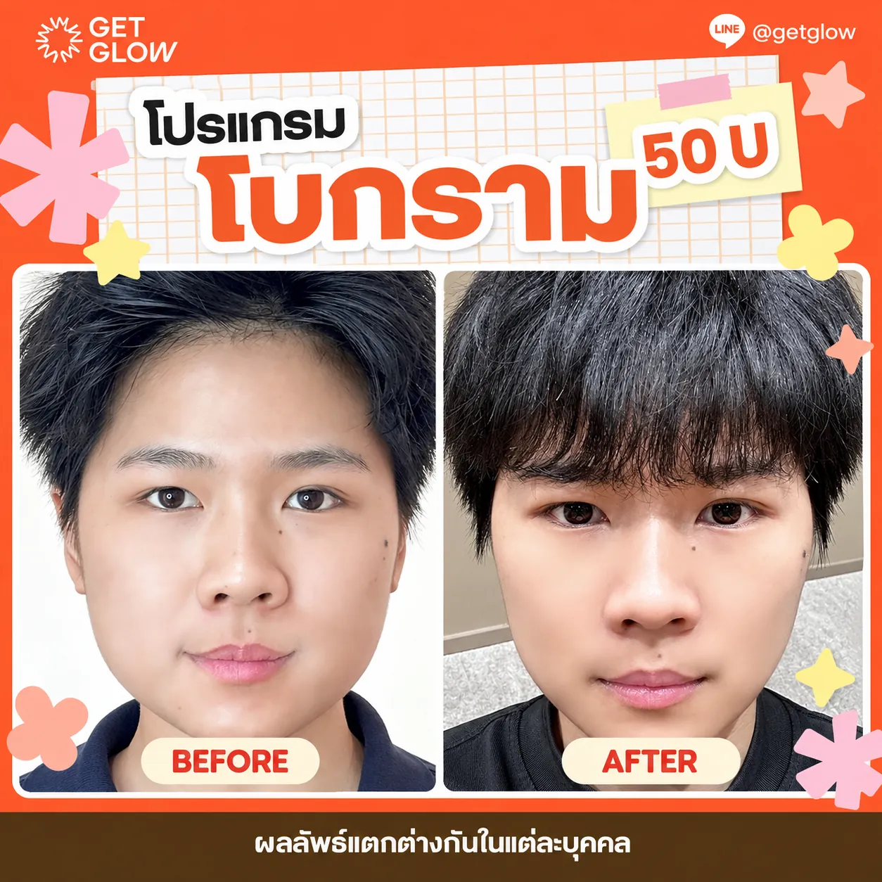รีวิวจริง โบท็อกซ์ — ลดกราม ที่ GETGLOW Clinic สยามสแควร์วัน