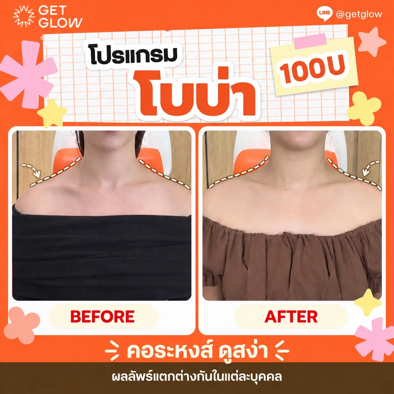 รีวิวจริง โบท็อกซ์ — บ่าและไหล่ ที่ GETGLOW Clinic สยามสแควร์วัน