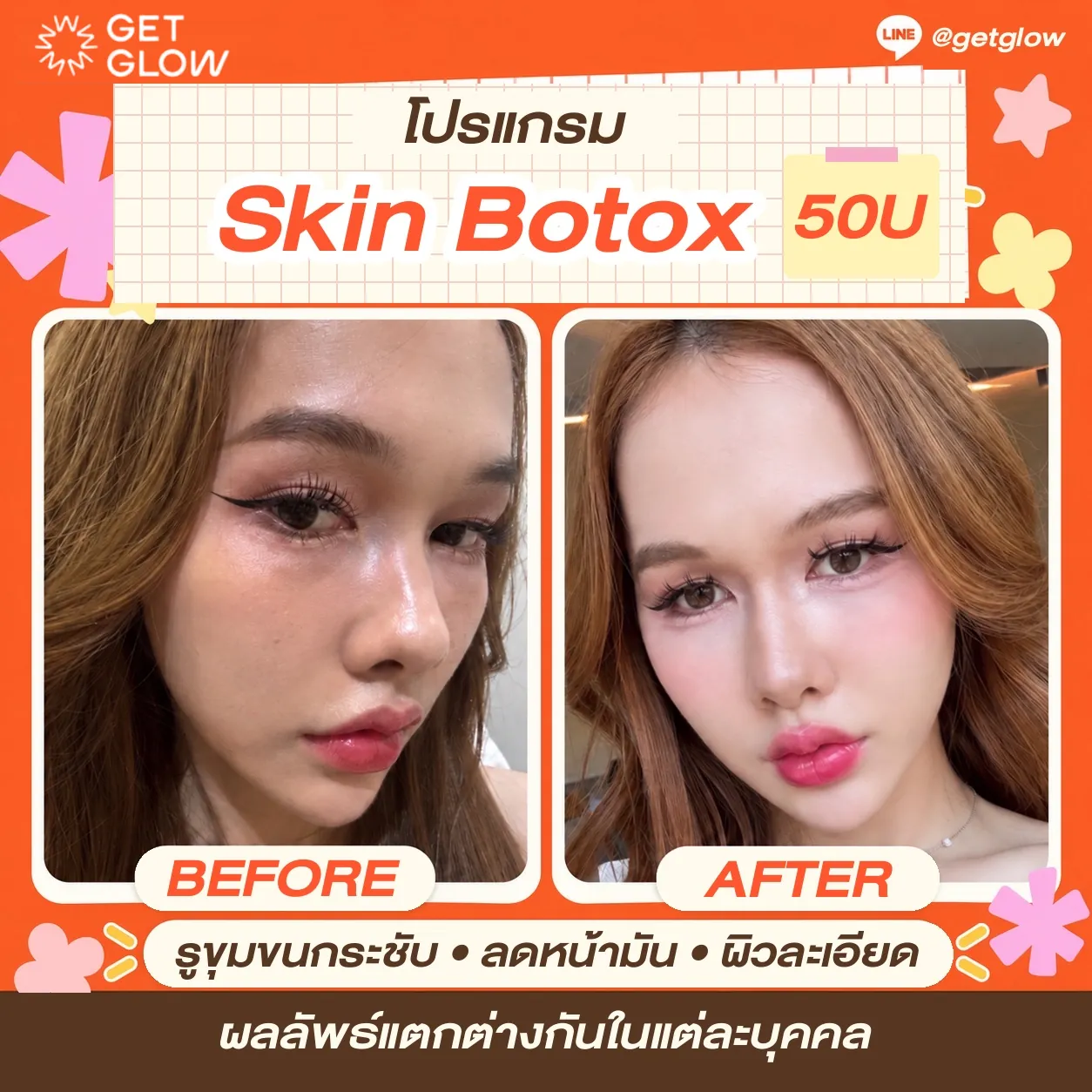 รีวิวจริง โบท็อกซ์ — Skin Botox ที่ GETGLOW Clinic สยามสแควร์วัน